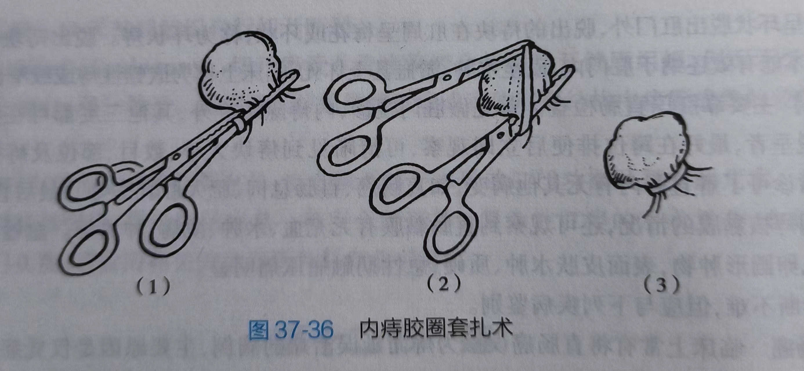 痔疮套扎手术图解图片