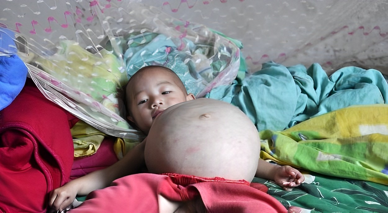 09年,漯河一女童身患怪病,年仅一岁半却挺着个大肚子,有何隐情