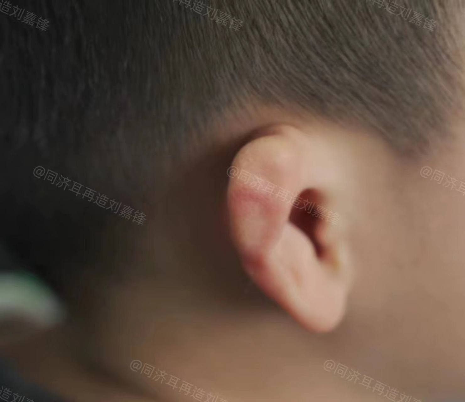 孩子右耳软骨缩在了一起,拉不开,看上去比左侧耳朵小了一圈,妈妈想