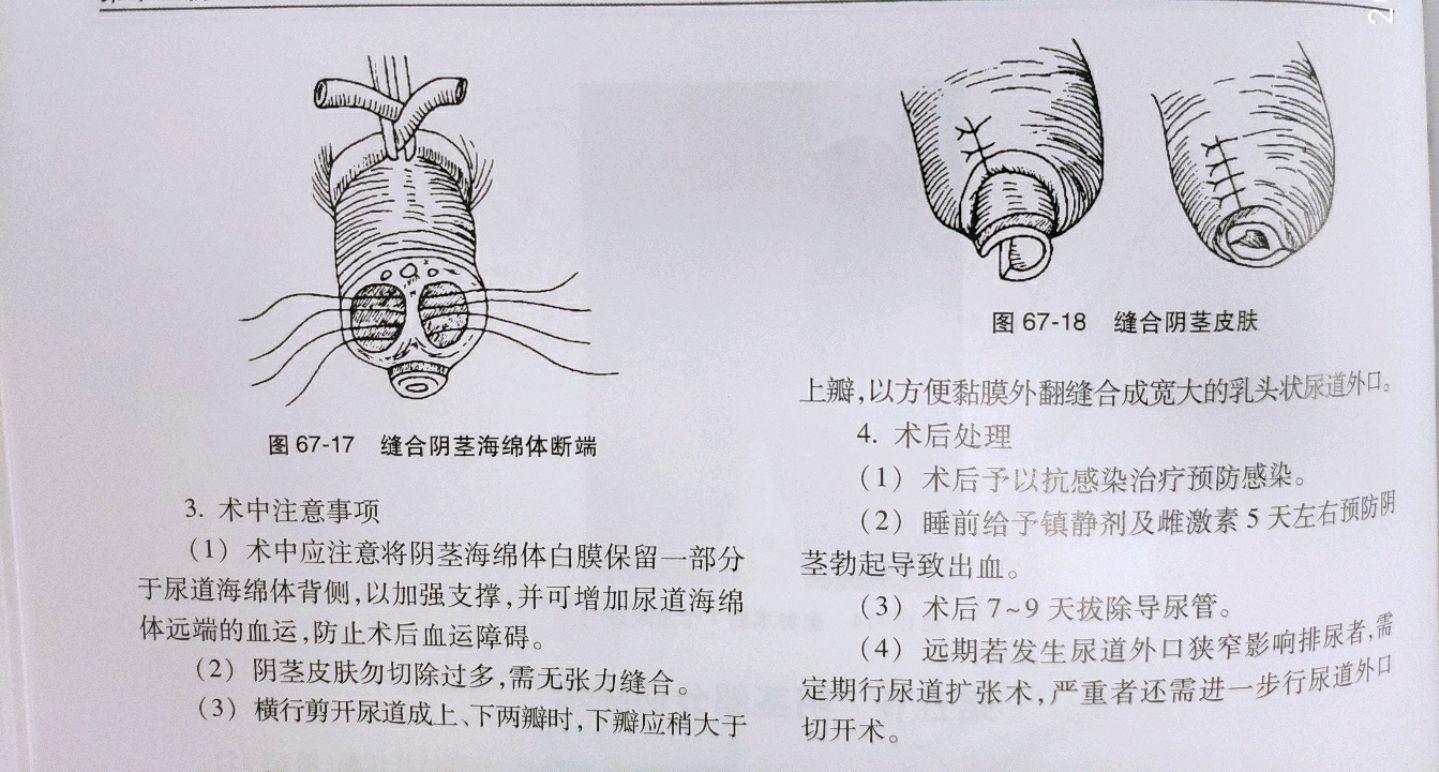 JJ切除三分之一图片