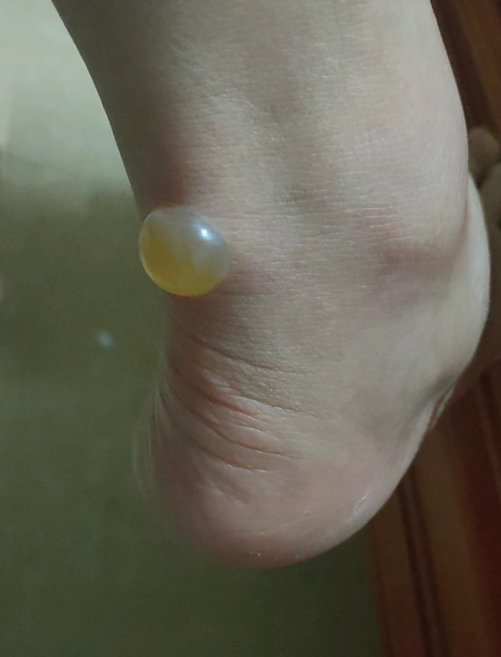 被蚂蚁咬了一口成这样,不懂是什么毒蚂蚁那么厉害.需要去医院处理吗?