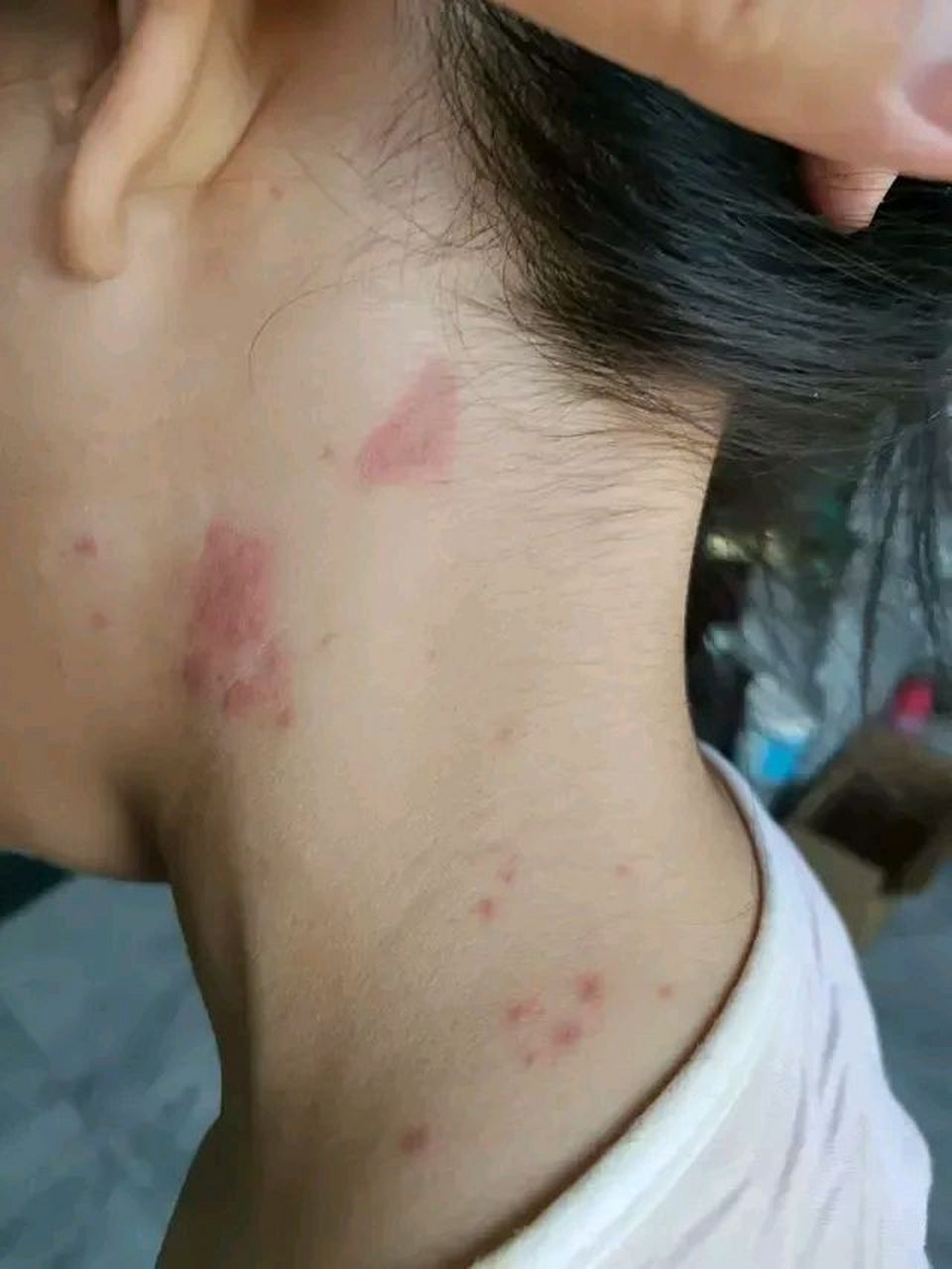 目前孩子没出现发烧的情况,但现在身上好几处都长了