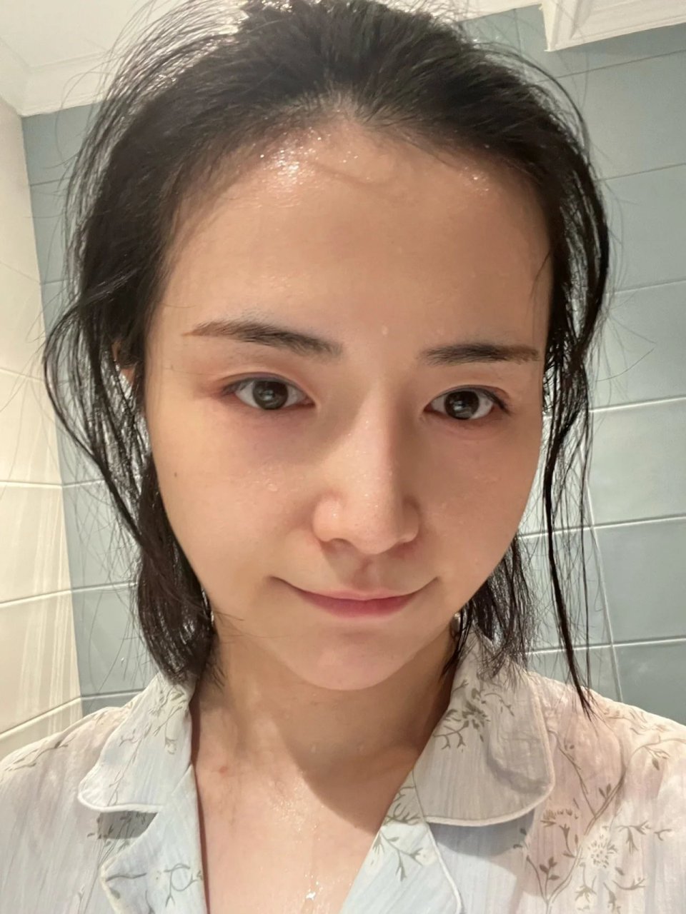 甲减病人成功摆脱水肿发胖!