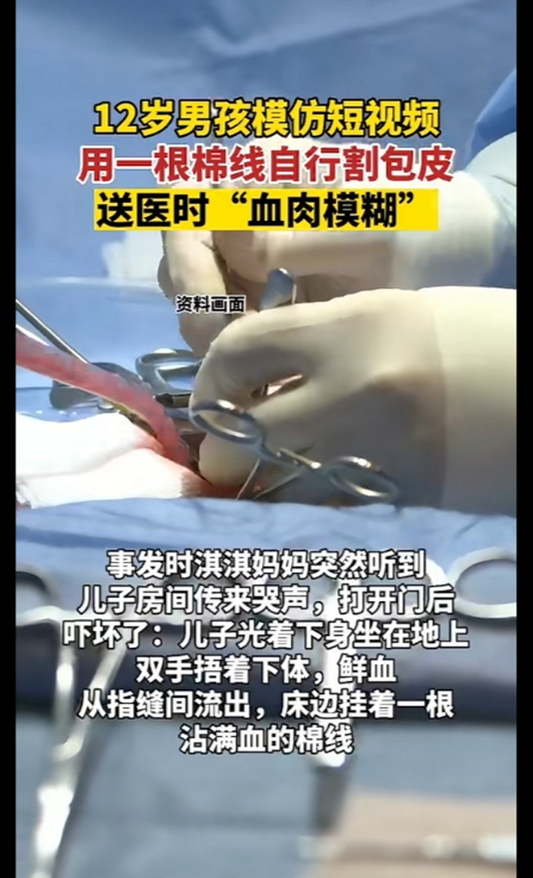 12岁男孩自己在房间里用棉线割包皮,结果把下身被弄的血肉模糊,直接进