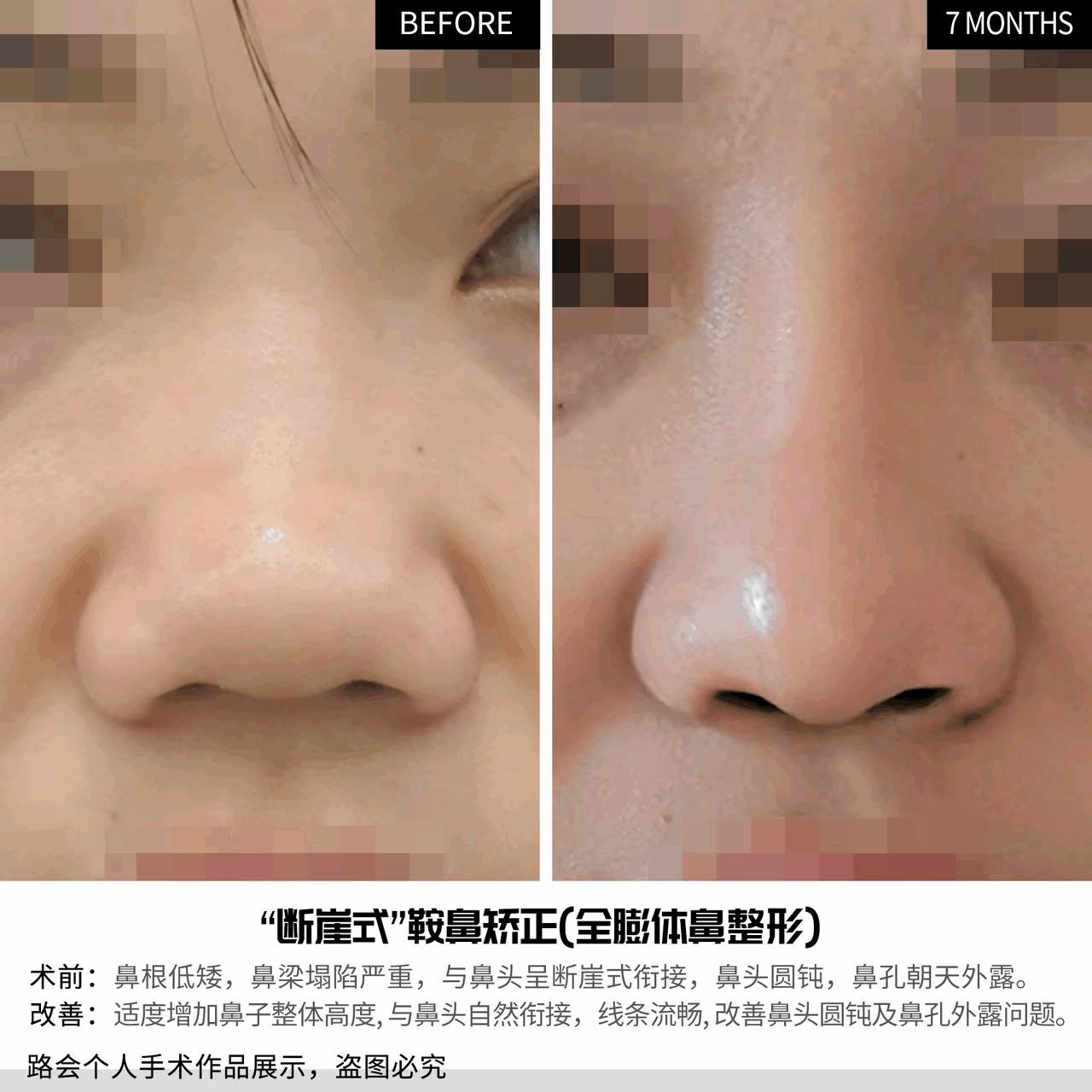 一个鼻子的改变…… 左:鼻梁扁塌,没有"海鸥线",鼻头朝天;右:鼻梁隆起