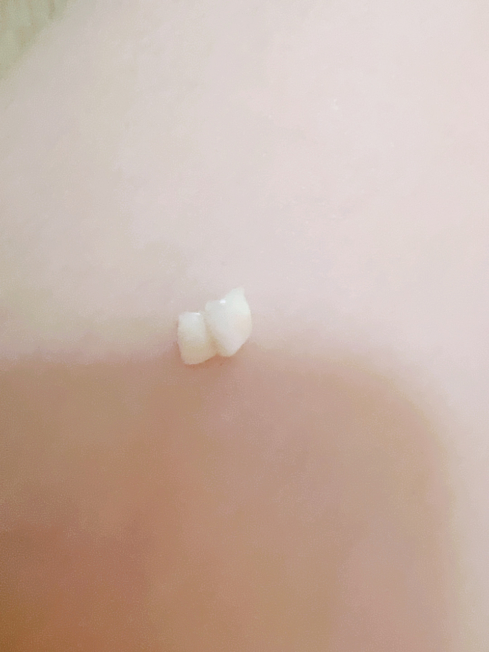 孩子今天掉了一颗牙,才发现这俩颗牙齿是长在一起的