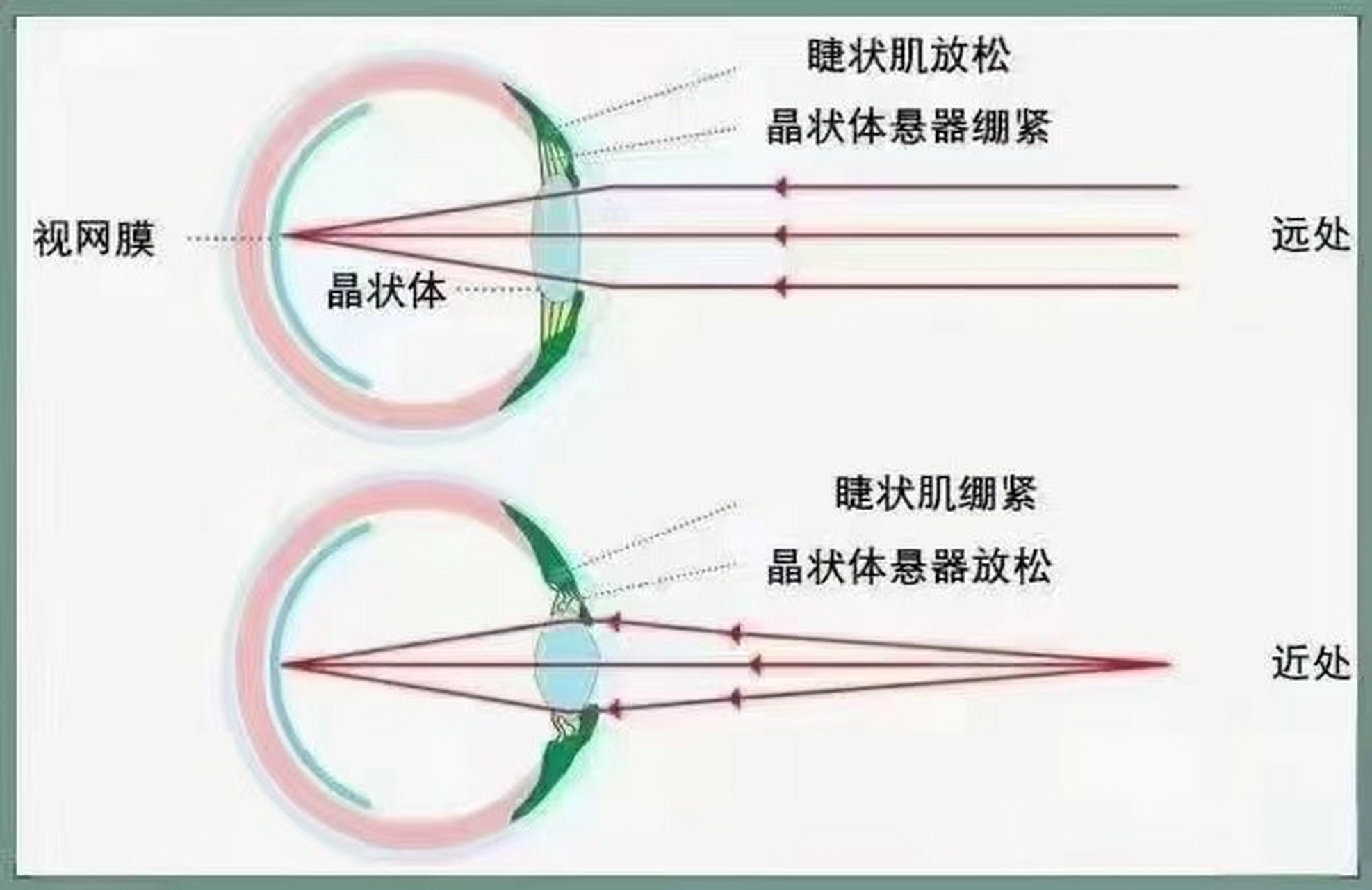 訓練睫狀肌和懸韌帶是提高視力的有效方法.