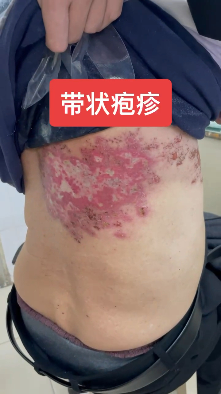 皮肤科医生告诉你:带状疱疹(蛇缠腰)一定要及时规范治疗哦!-度小视