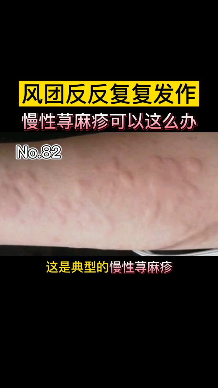 风团反反复复发作,慢性荨麻疹可以这么办