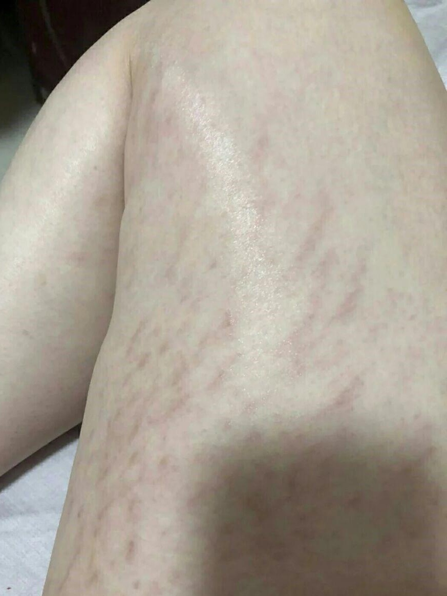 青少年生长纹怎么去除  青少年生长纹一旦出现,通常是无法彻底去除的