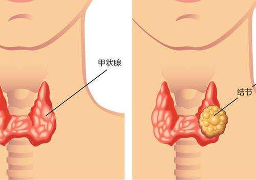 甲状腺结节长在哪里图片