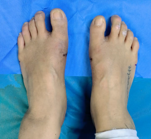 25岁地铁工作人员拇外翻,做个手术告别职业病