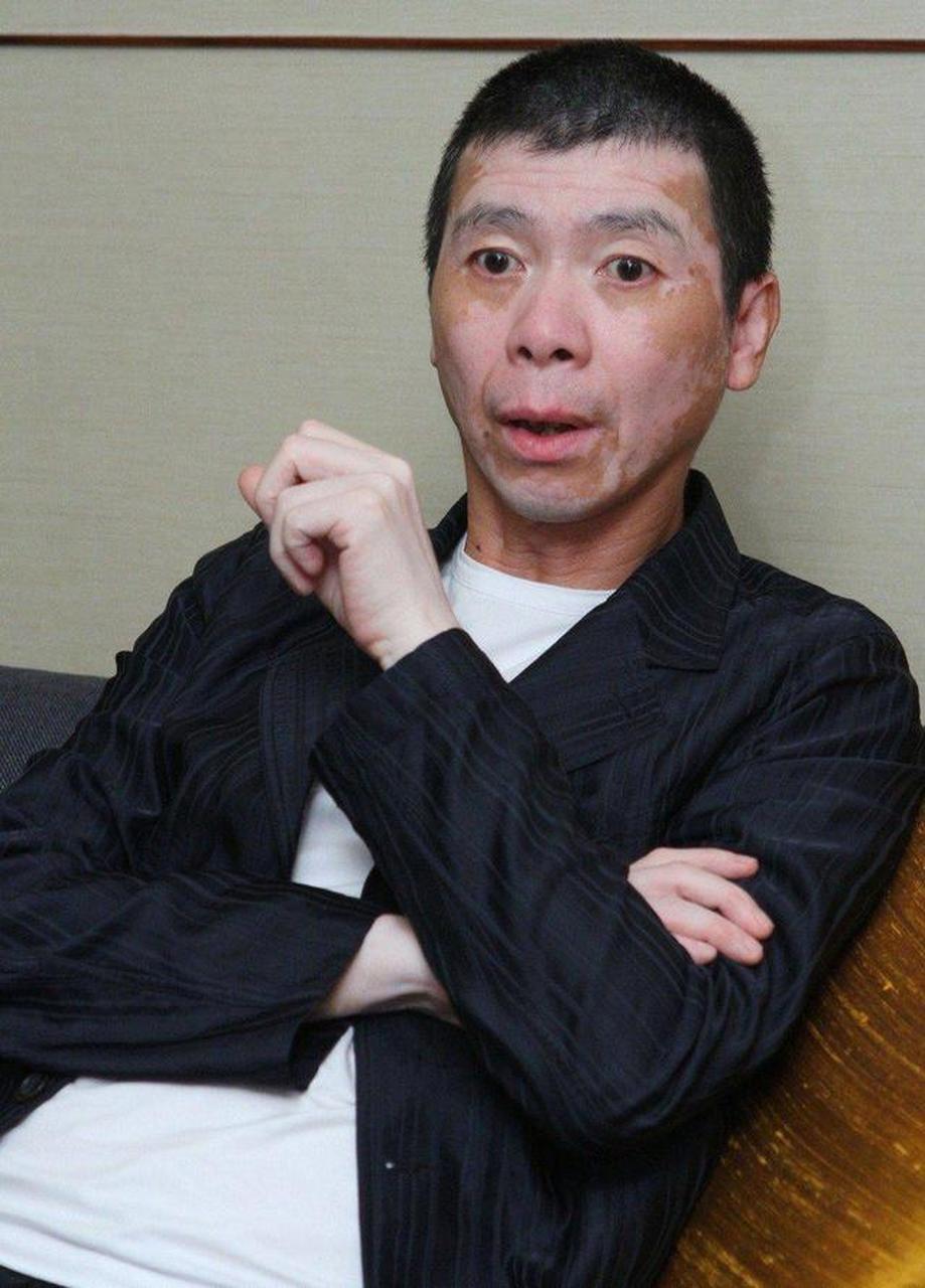 近日冯小刚脸上白癜风消失的消息引起了人们广泛关注