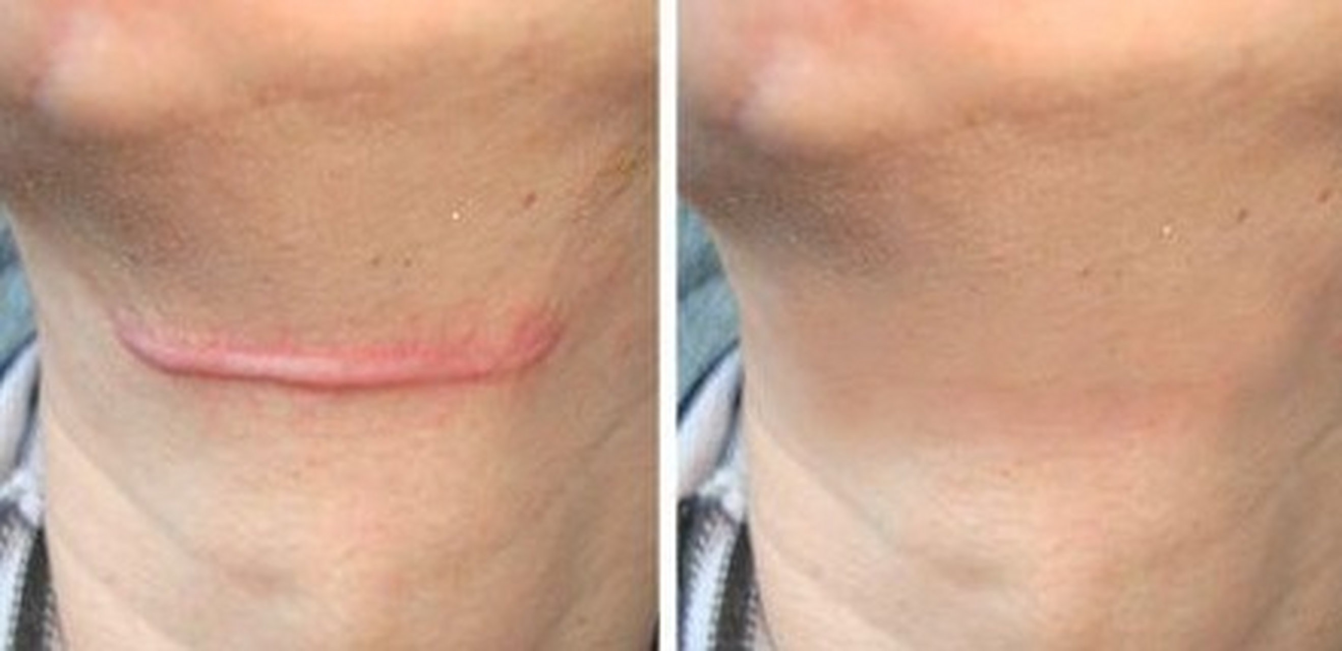 疤痕是伤口愈合后留下的痕迹,常常让人感到困扰.