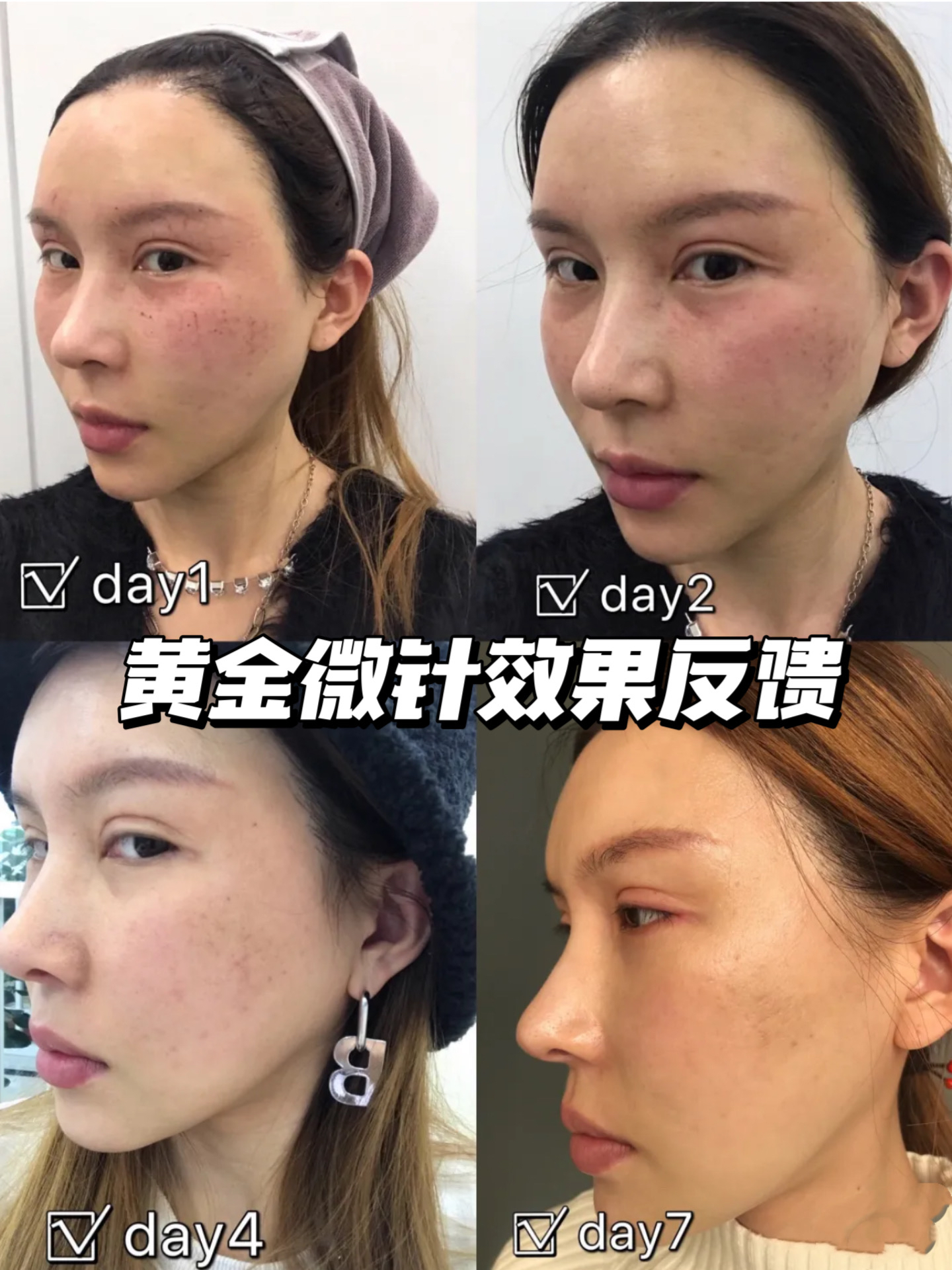 黄金微针不仅可以祛痘还能美白亮肤