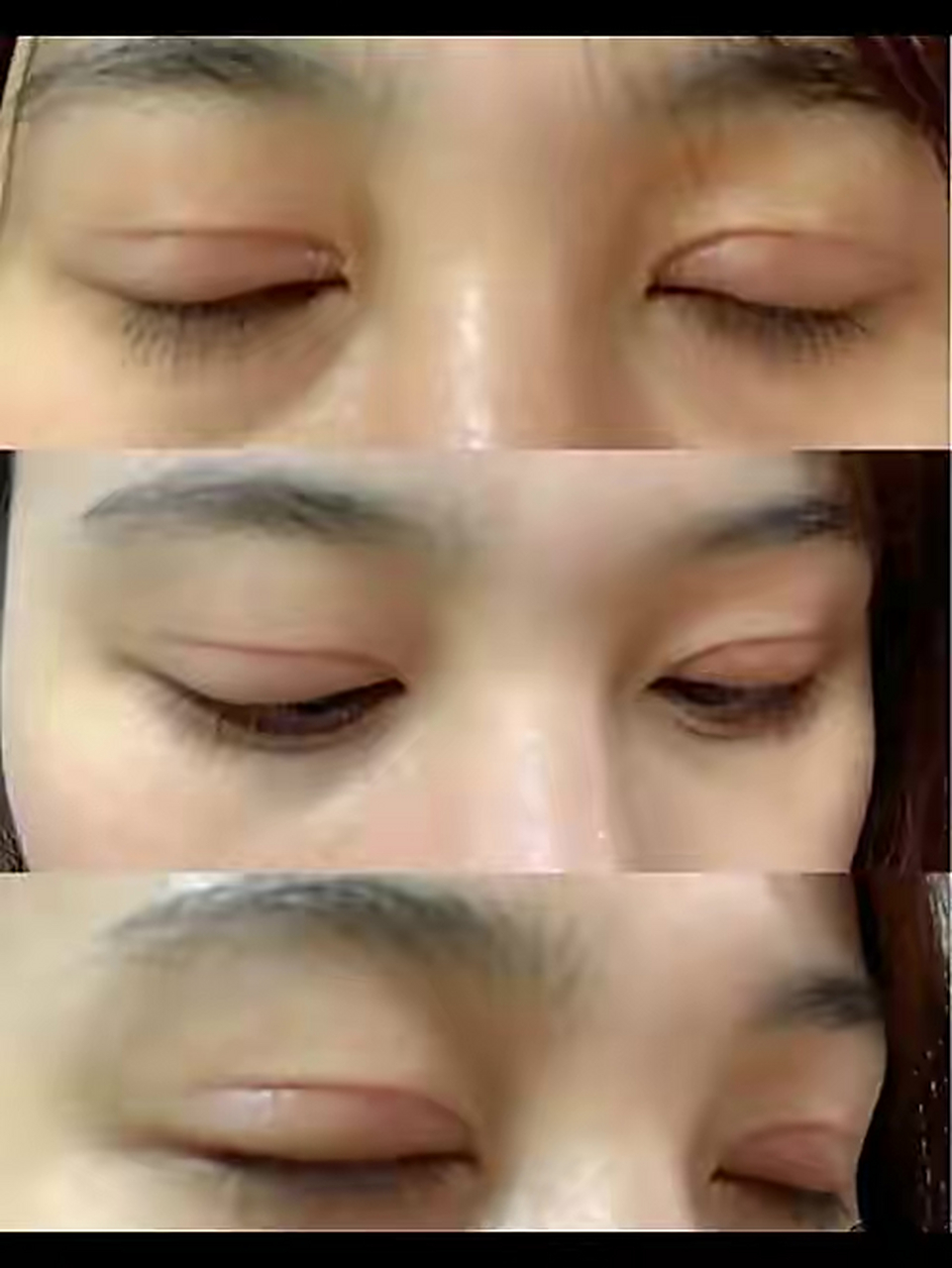 埋线双眼皮能维持几年?