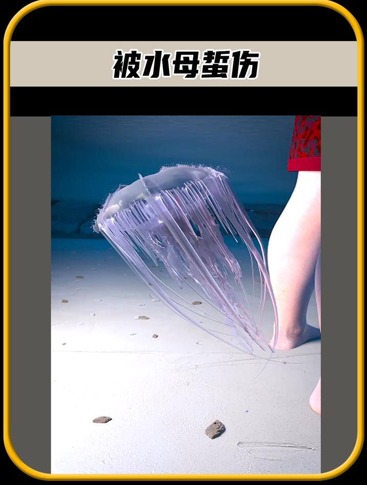 假如你小子在海边游玩时,不慎被水母蜇伤,可以这样处理
