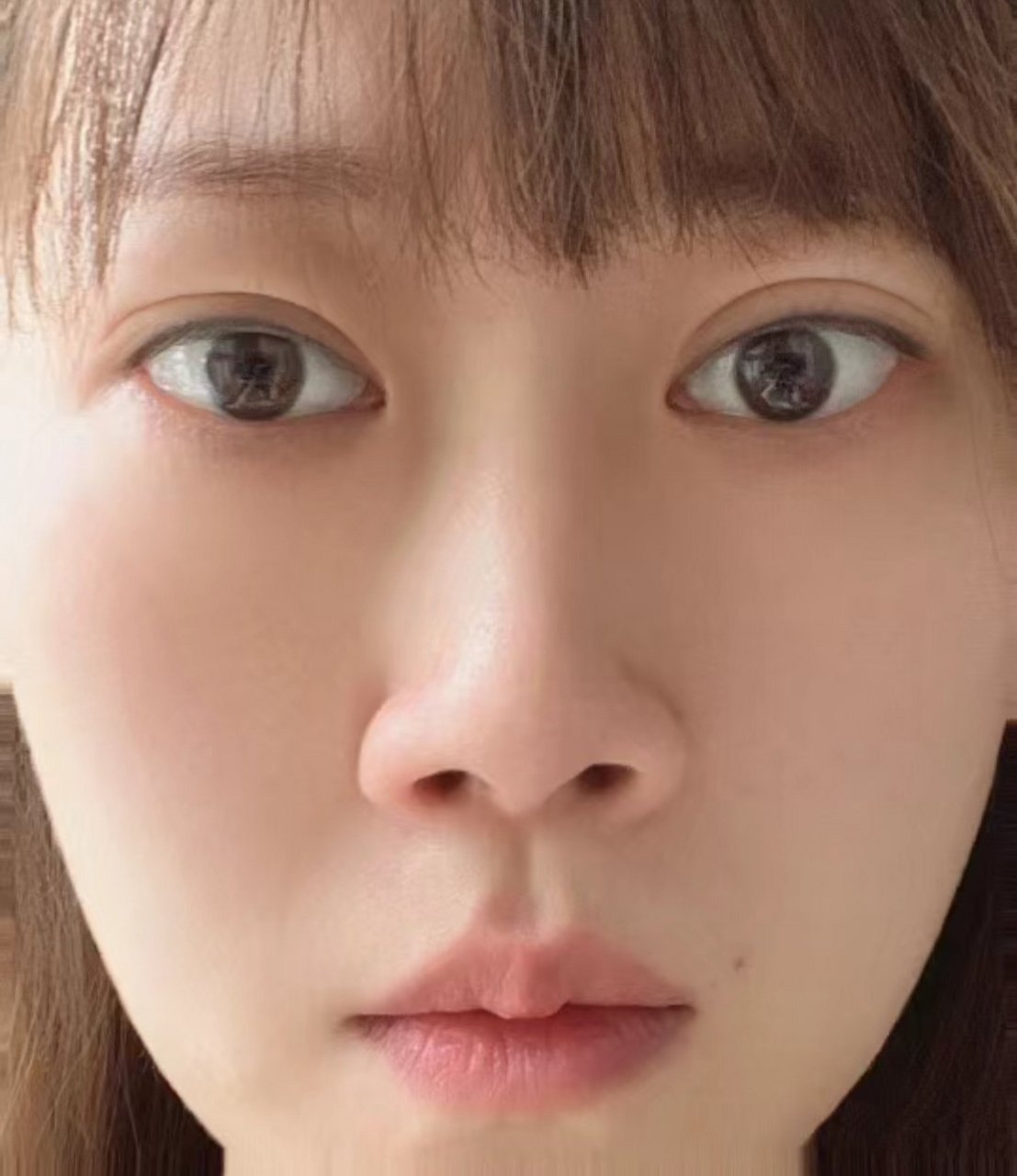 甲亢好了! 细看眼睛对比图