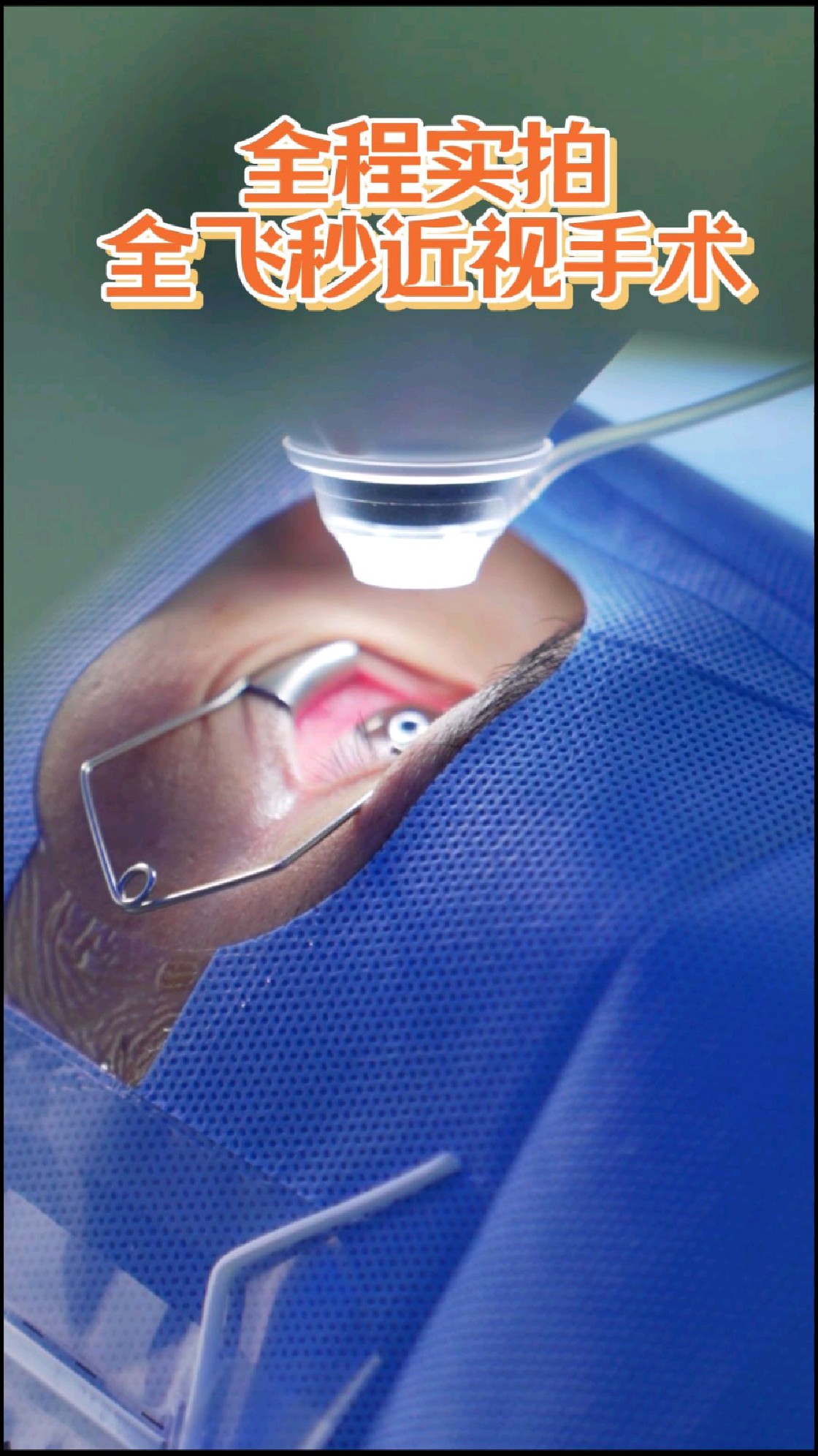 实拍全飞秒激光手术#眼科医生杨云#近视手术#全飞秒激光手术