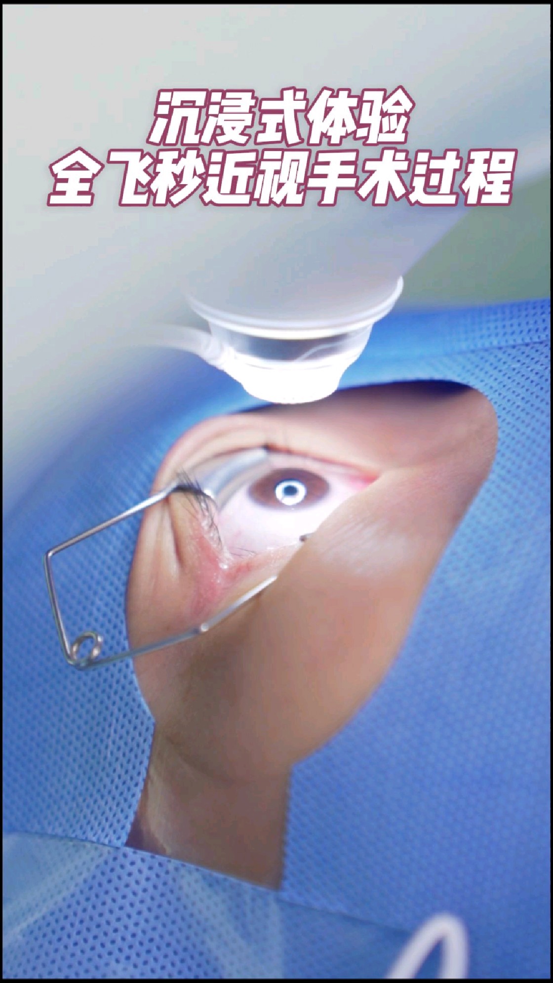 沉浸式体验全飞秒激光手术过程#眼科医生杨云#近视手术