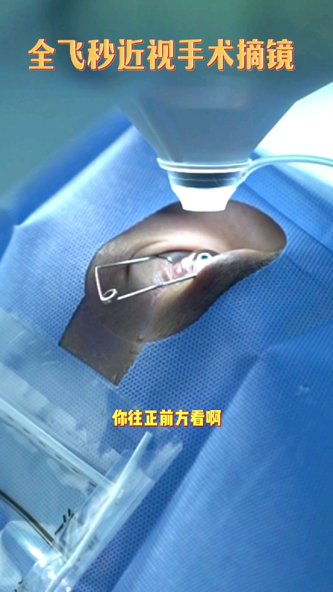 全飞秒激光手术,过程中医生全程引导,不紧张放轻松是最好的配合