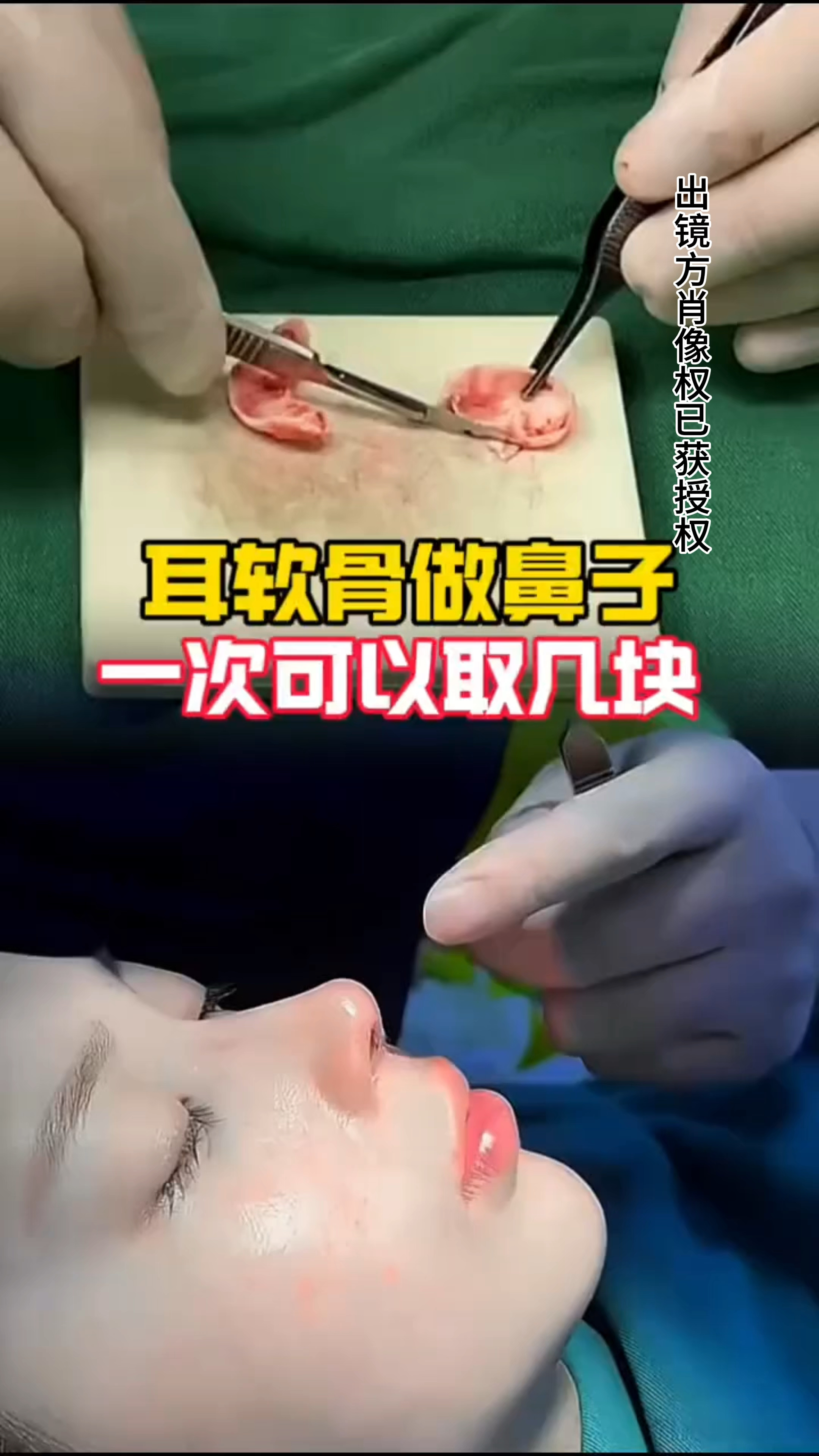 耳软骨再生图片