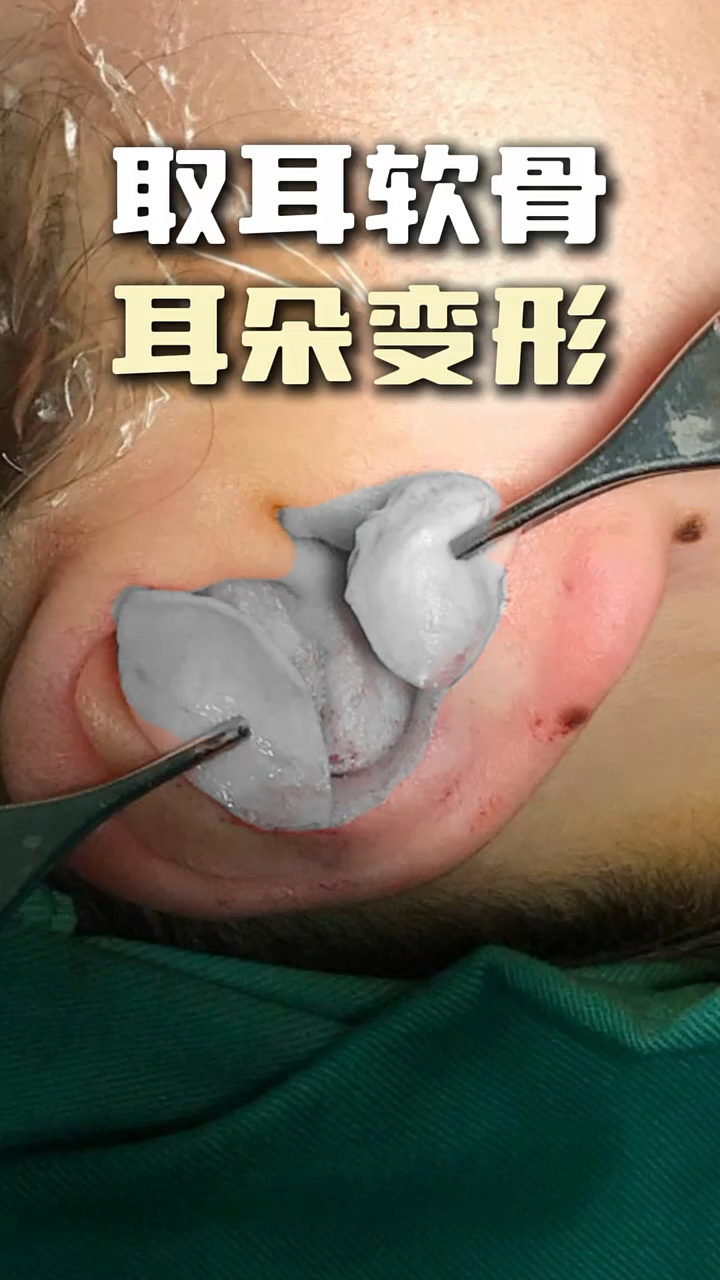 取耳软骨后耳朵变形?