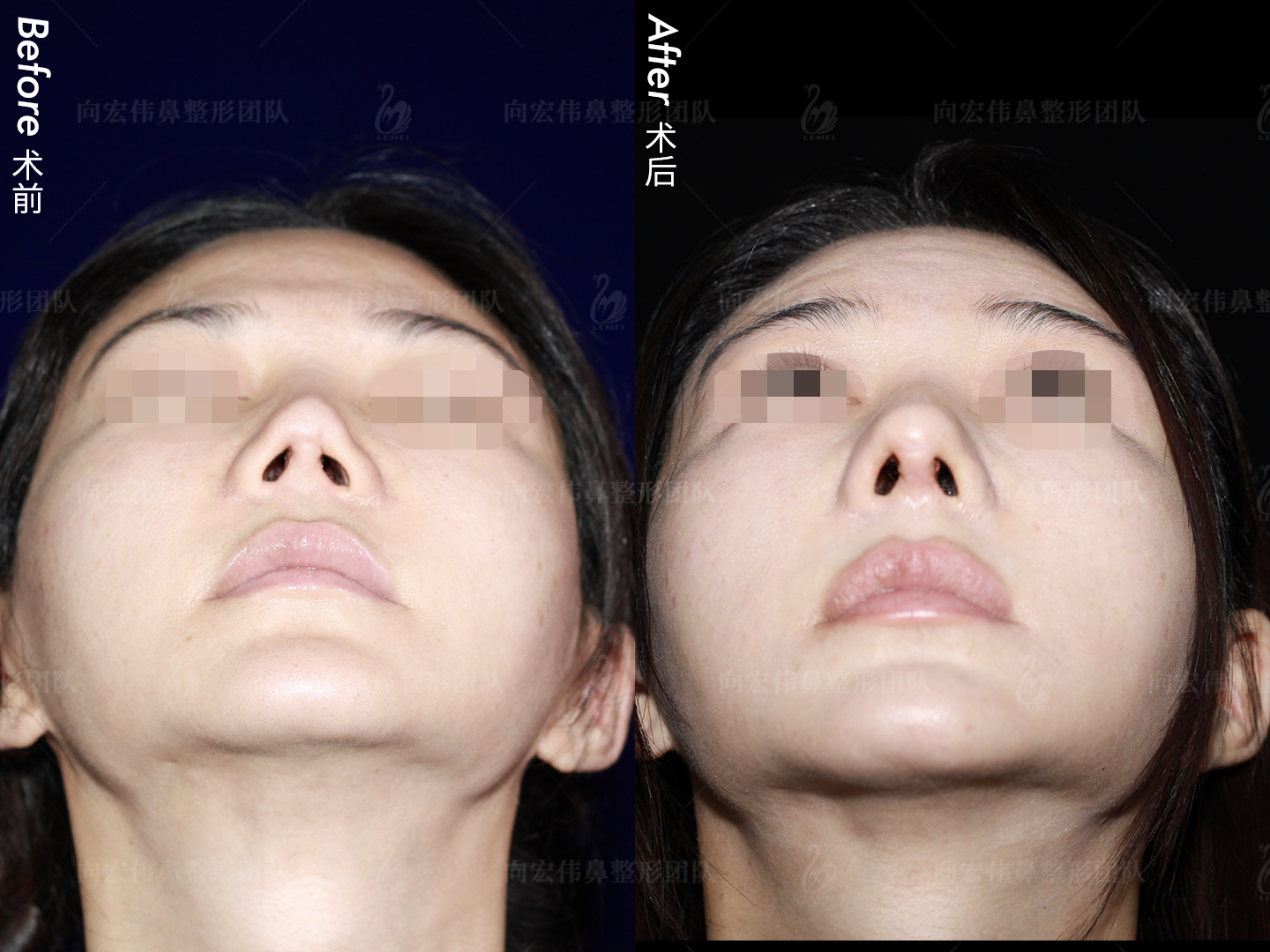 挛缩修复鼻朝天漏鼻孔鼻尖下小叶吸收缺失鼻头夹捏畸形鼻内疤痕重