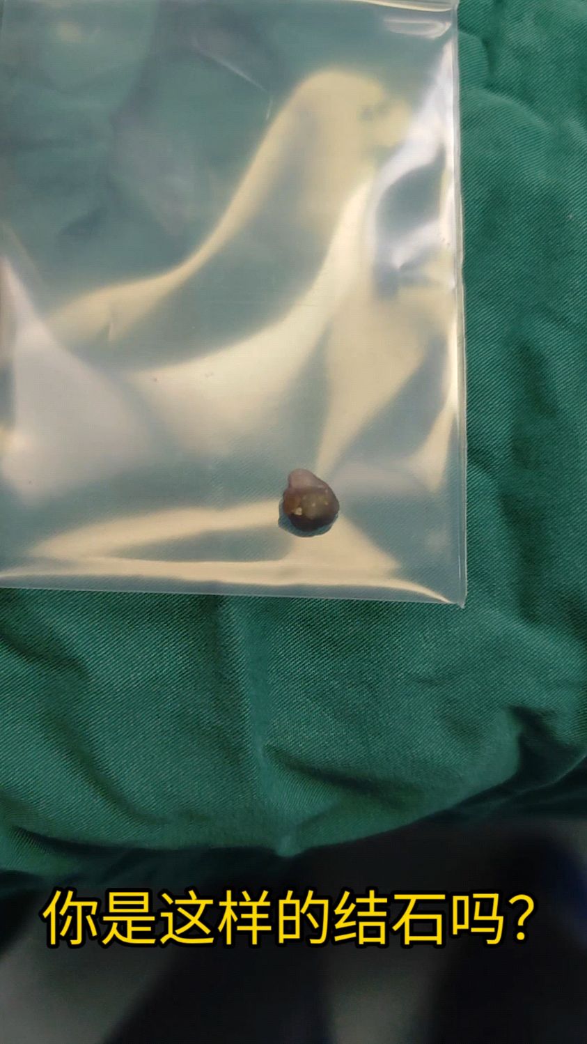 你是这样的结石吗?黑又硬哦