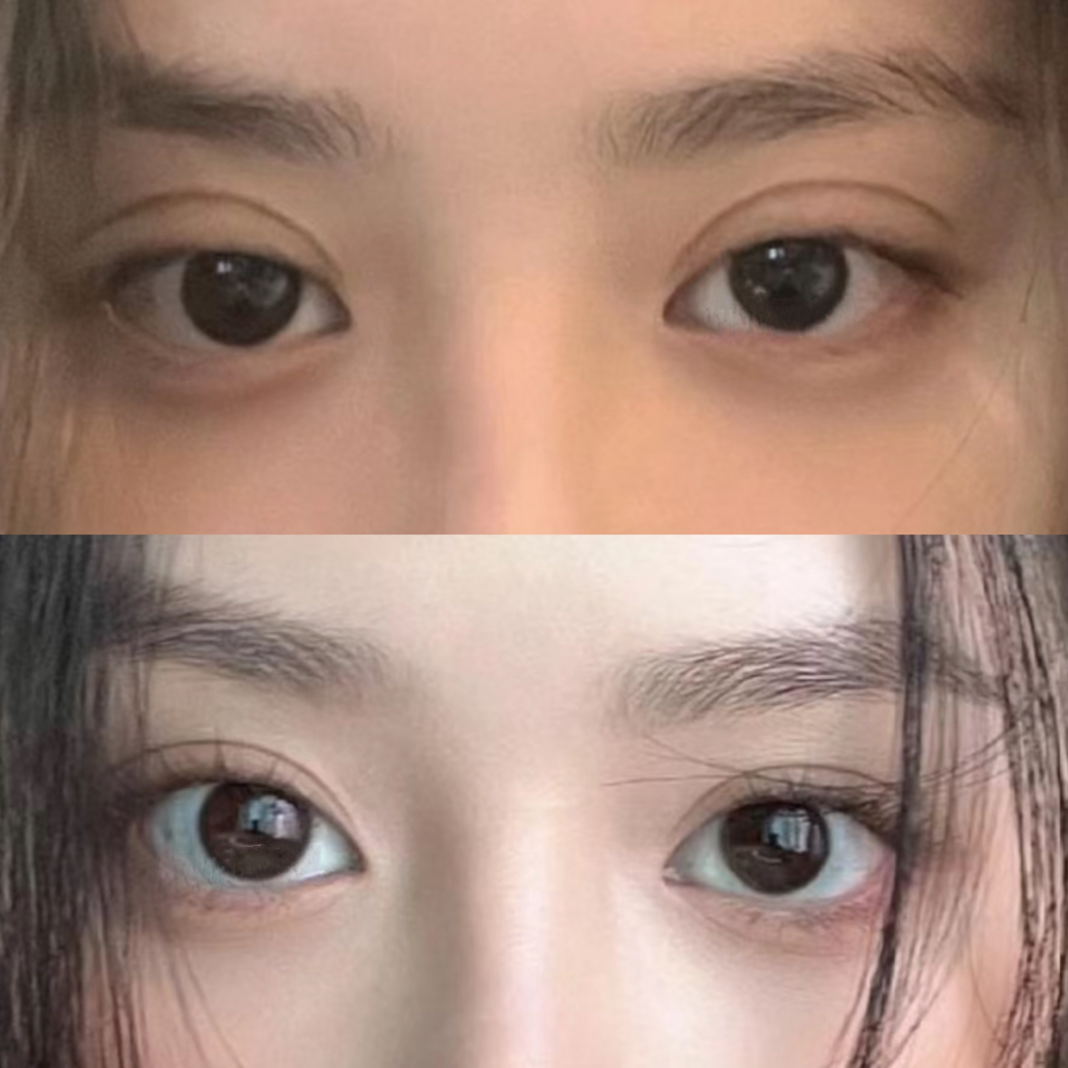 术后1个月,双眼皮宽度降低,眼睛幼态可爱!