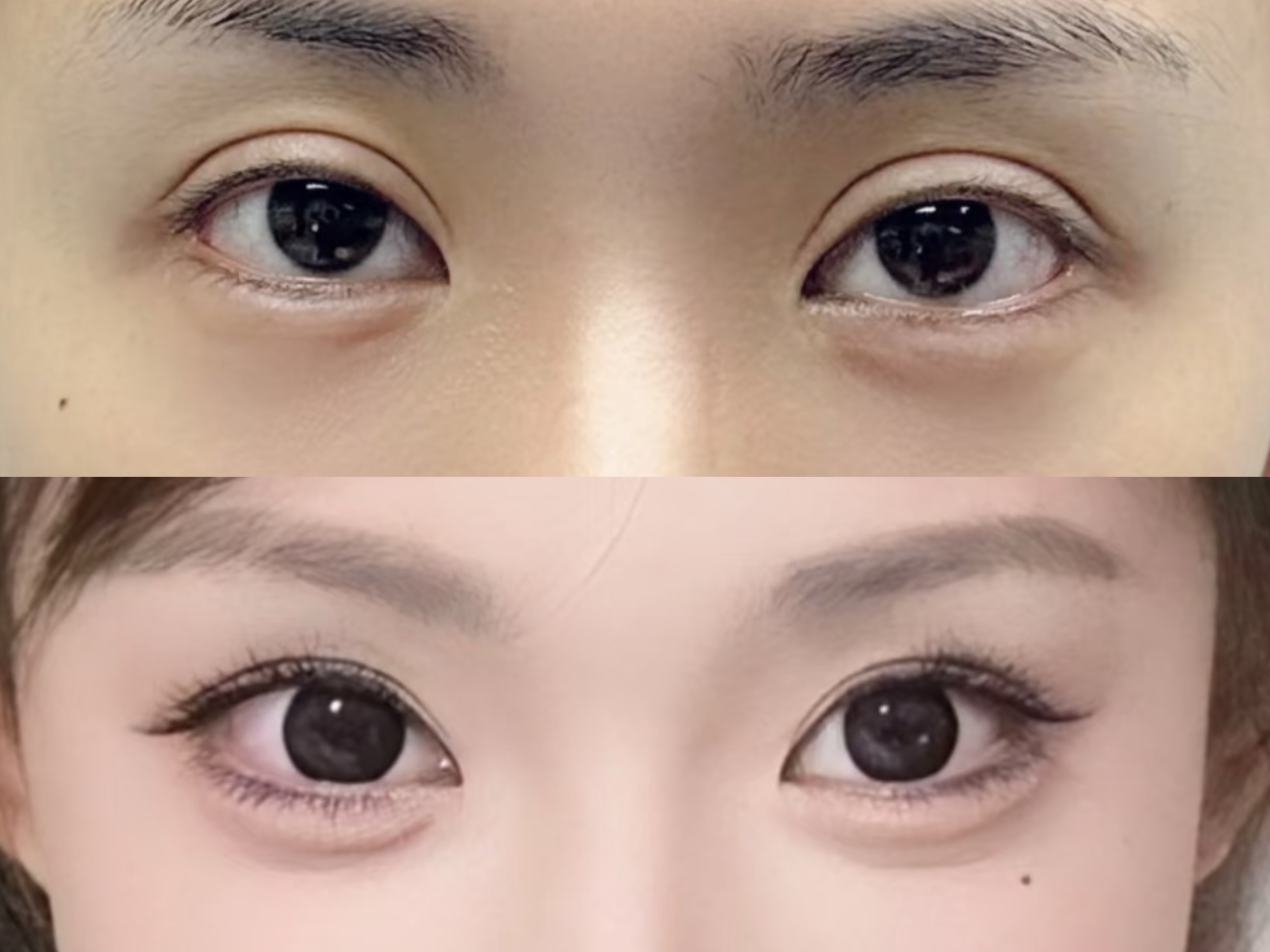 该求美者术前双眼皮过宽,显老,有肉条感