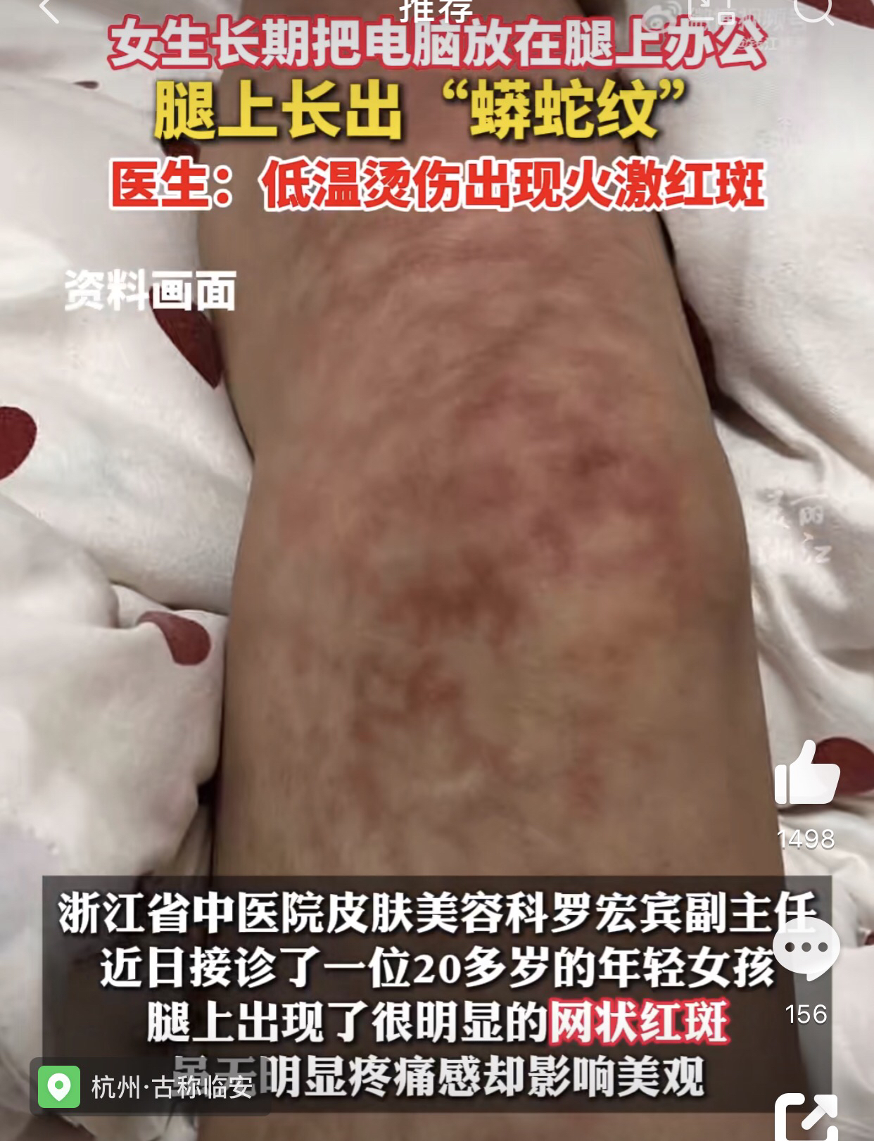 医生:火激红斑不好治