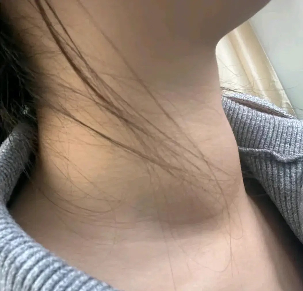 前段时间我发现我闺蜜有点不对劲,脖子变粗了不说,没刻意减肥体重却降