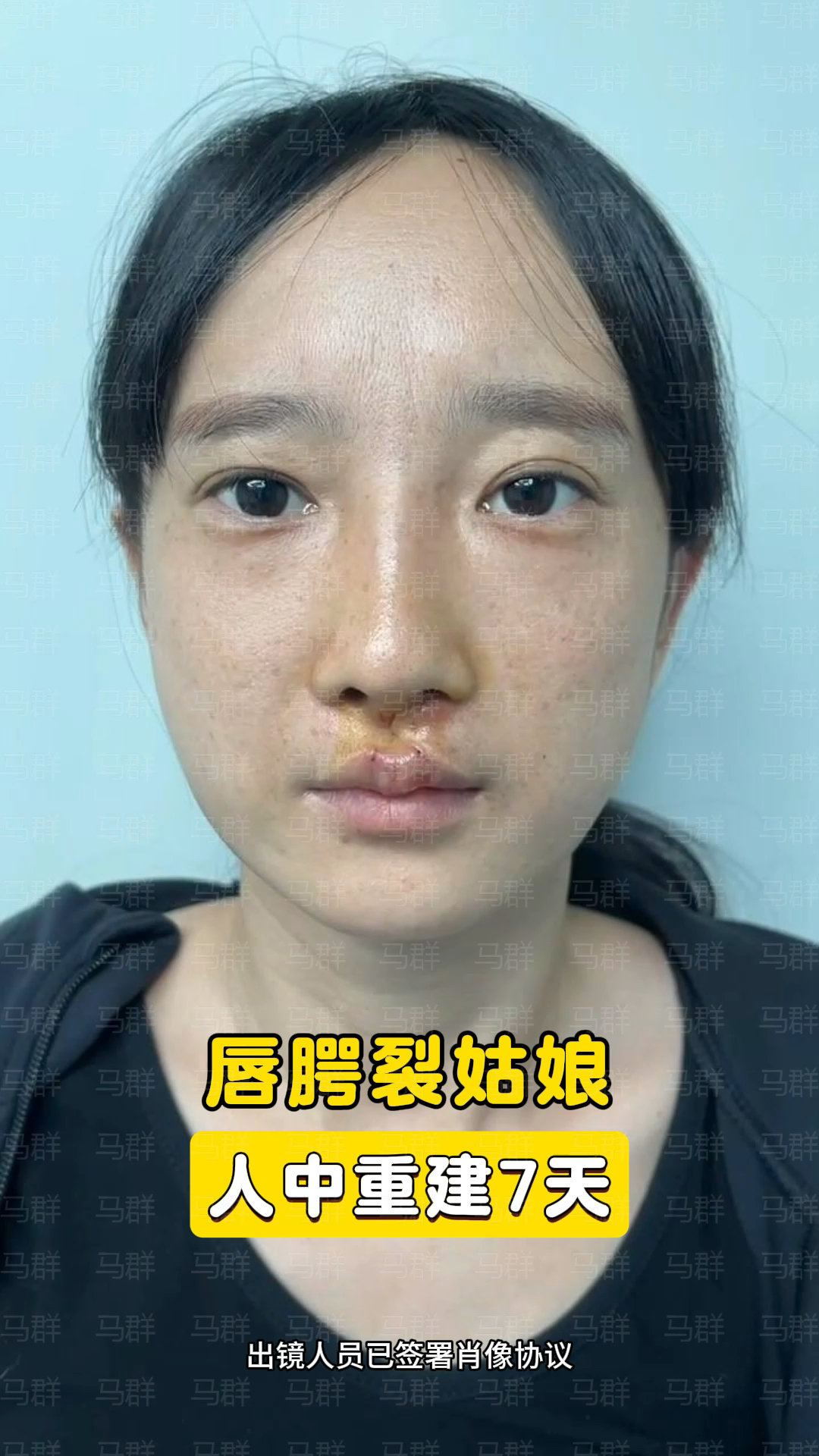 唇腭裂姑娘术后7天,恢复非常好,唇形基本接近正常唇形