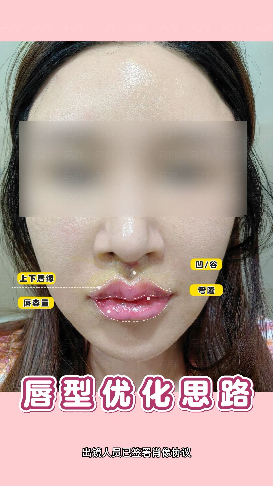 唇综合20天,颜值漂亮多了