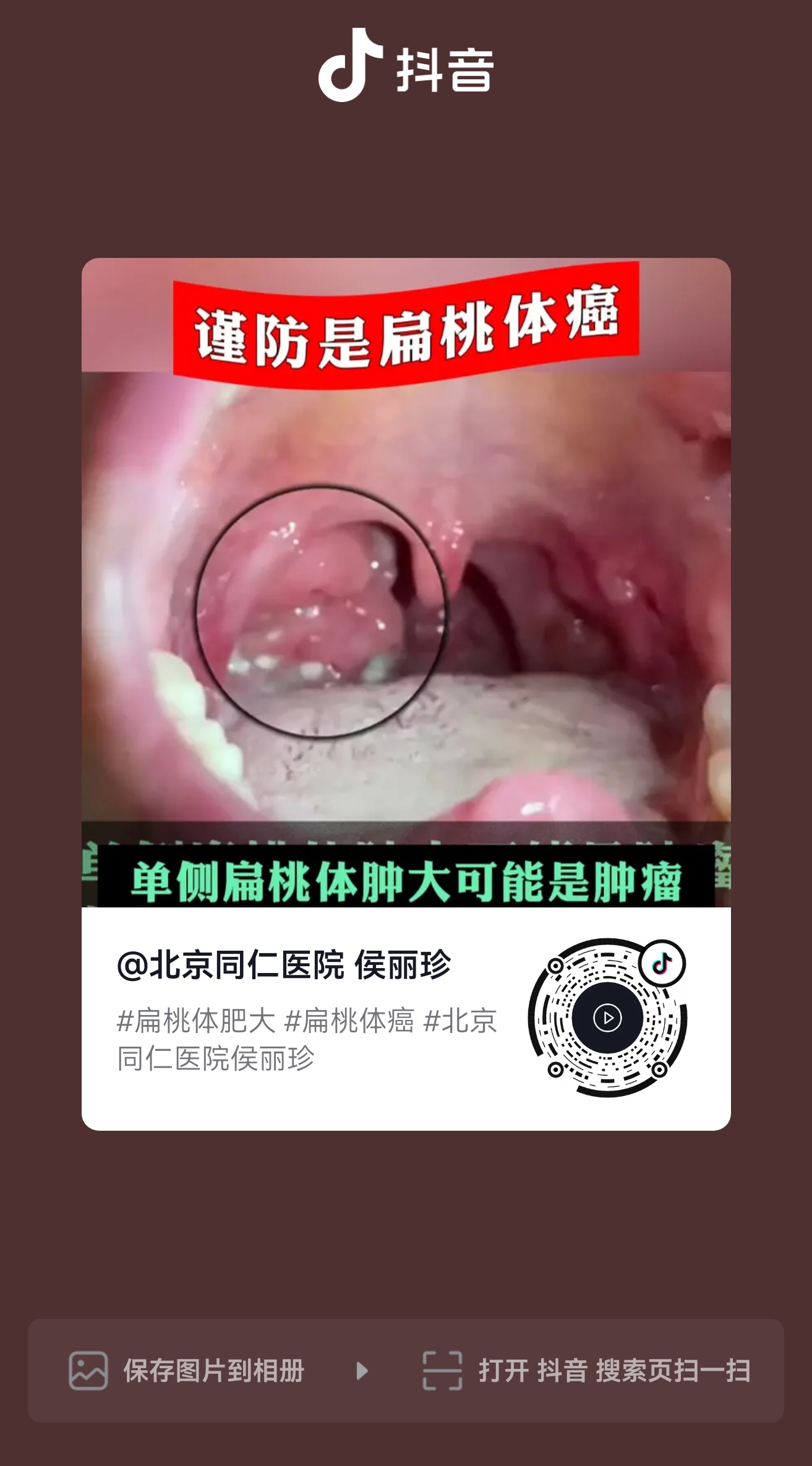扁桃体肿瘤早期10个症状