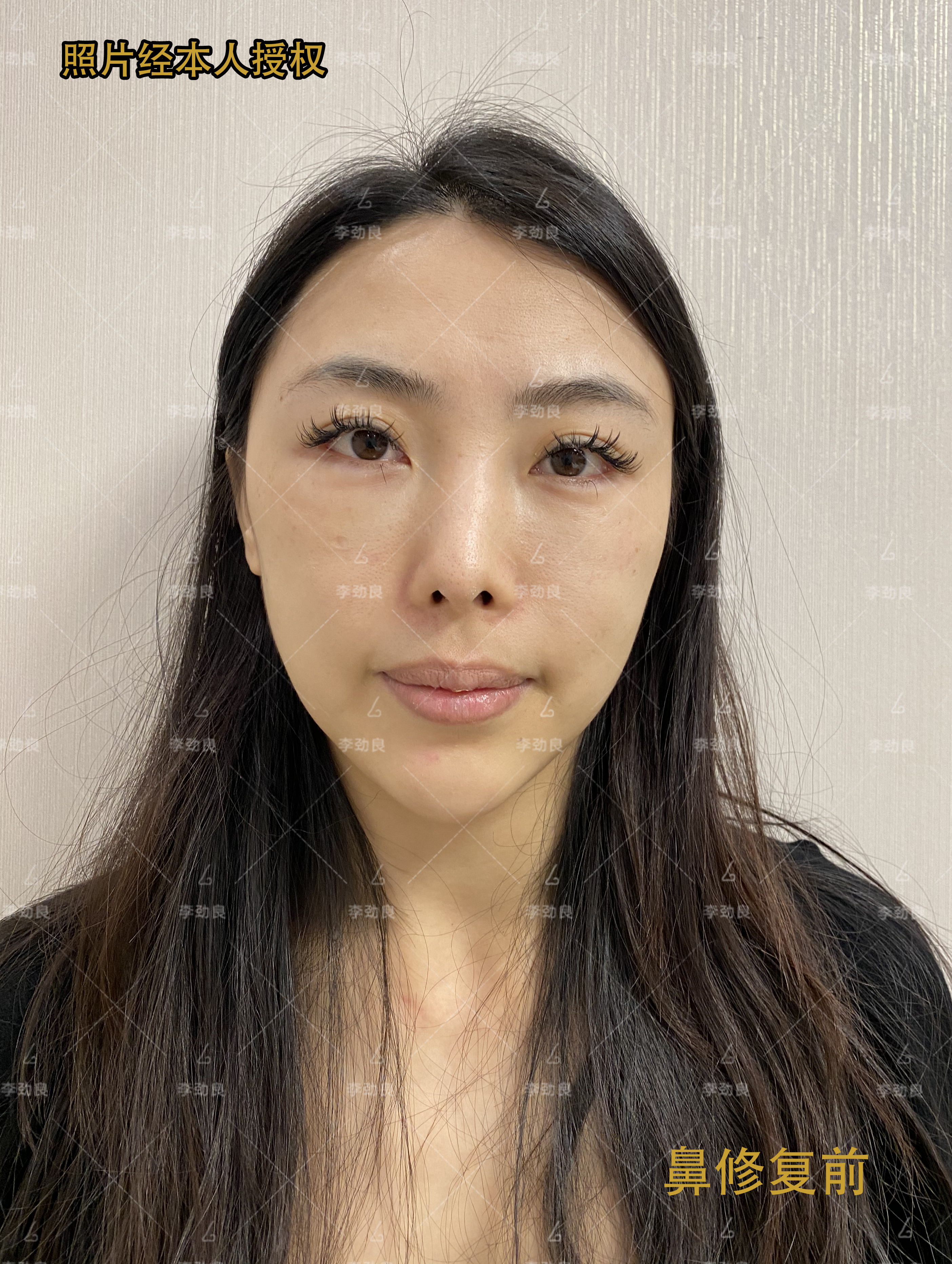 鼻子材料可谓是被我折腾个变韩国潮流也赶过玻尿酸l型硅胶硅胶