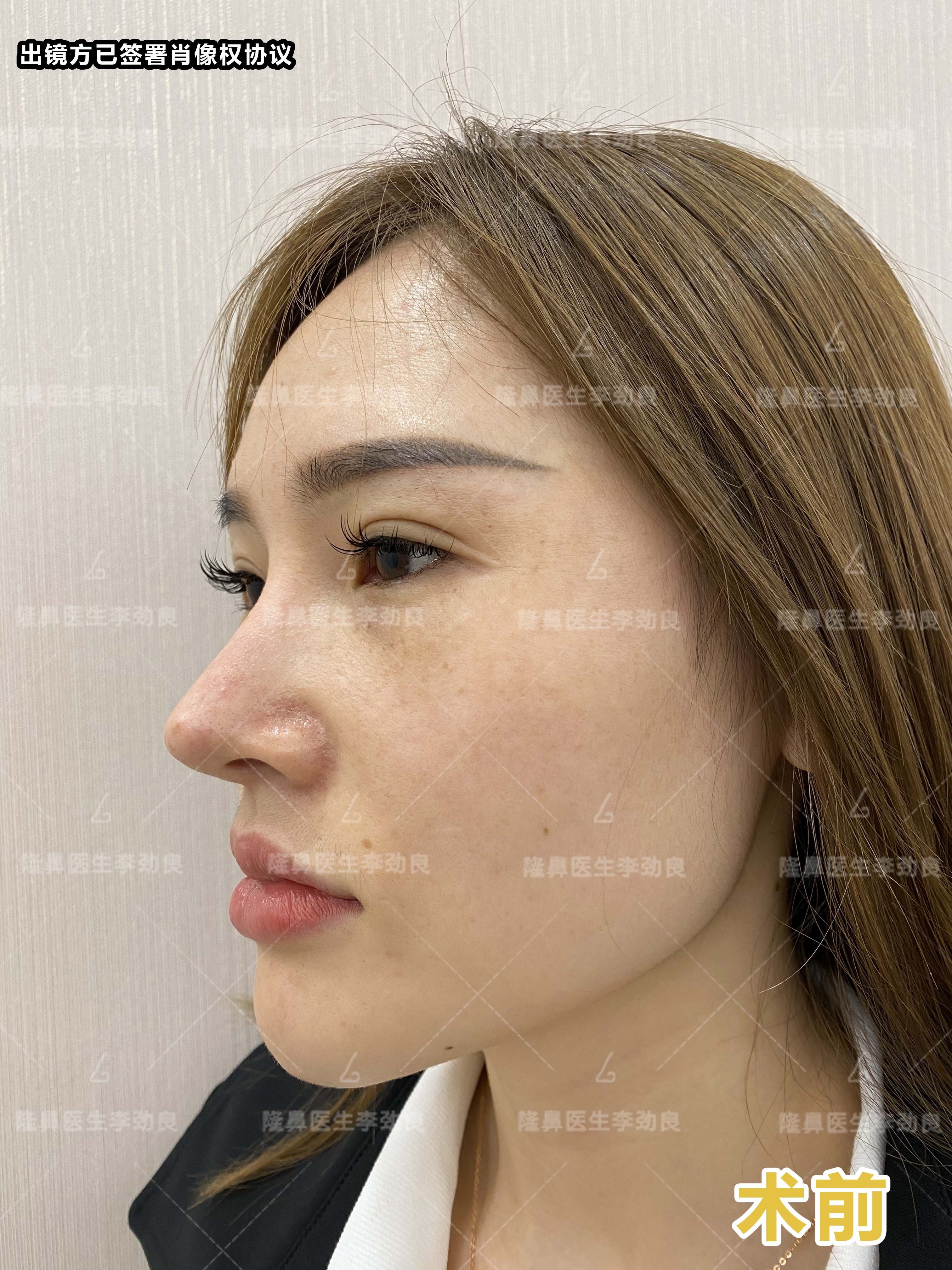 照片经本人授权鼻修复