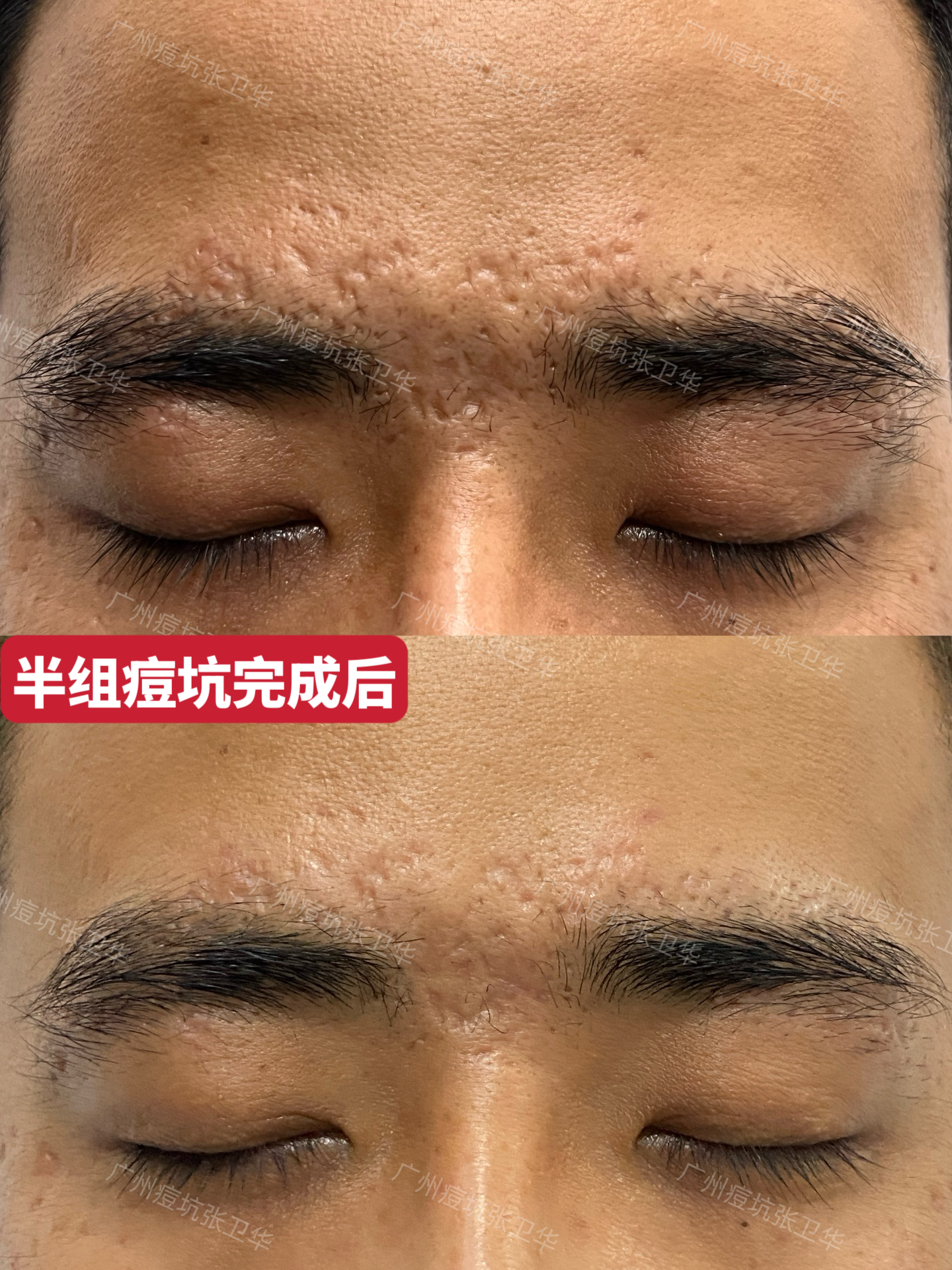 两边脸颊的痘印为什么很难消