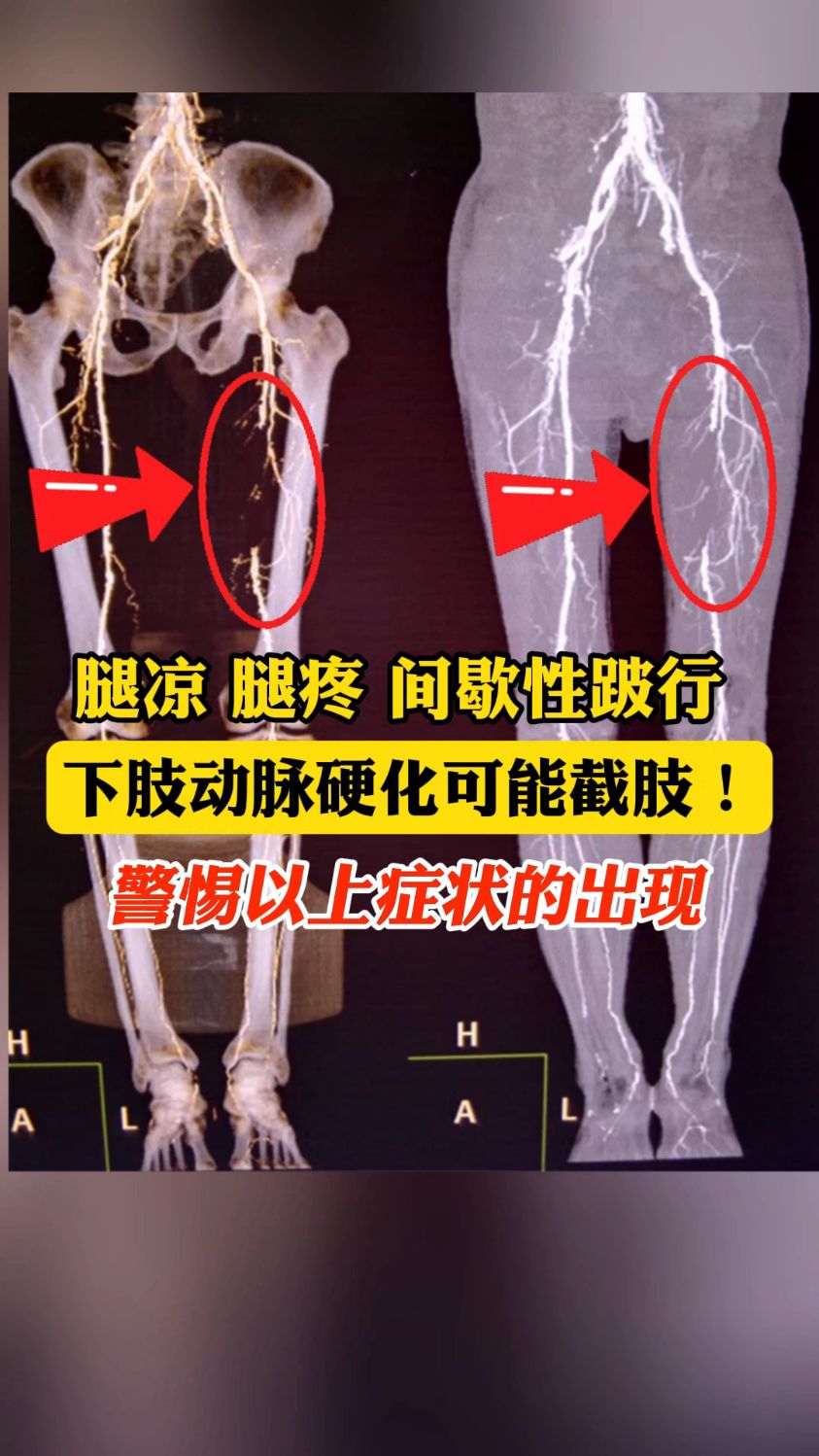 双下肢动脉硬化图片图片