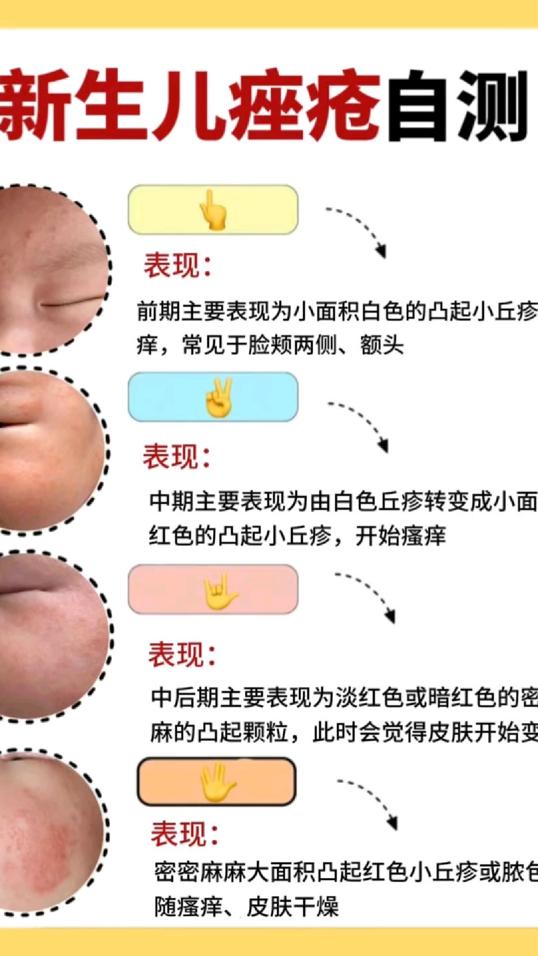 新生儿痤疮痘痘粉刺是怎么回事?石家庄明德皮肤病医院怎么样