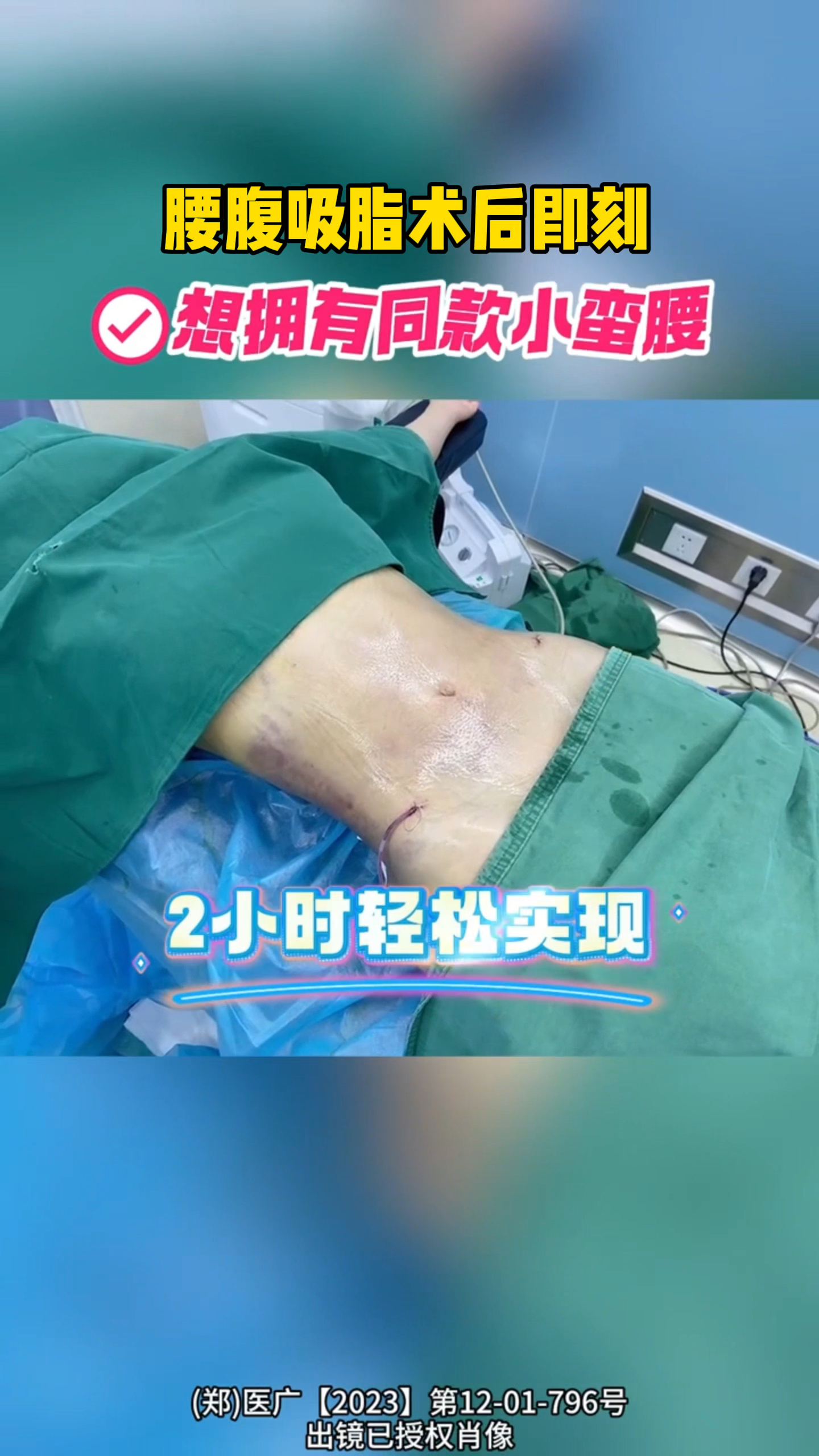 腰腹吸脂术后即刻