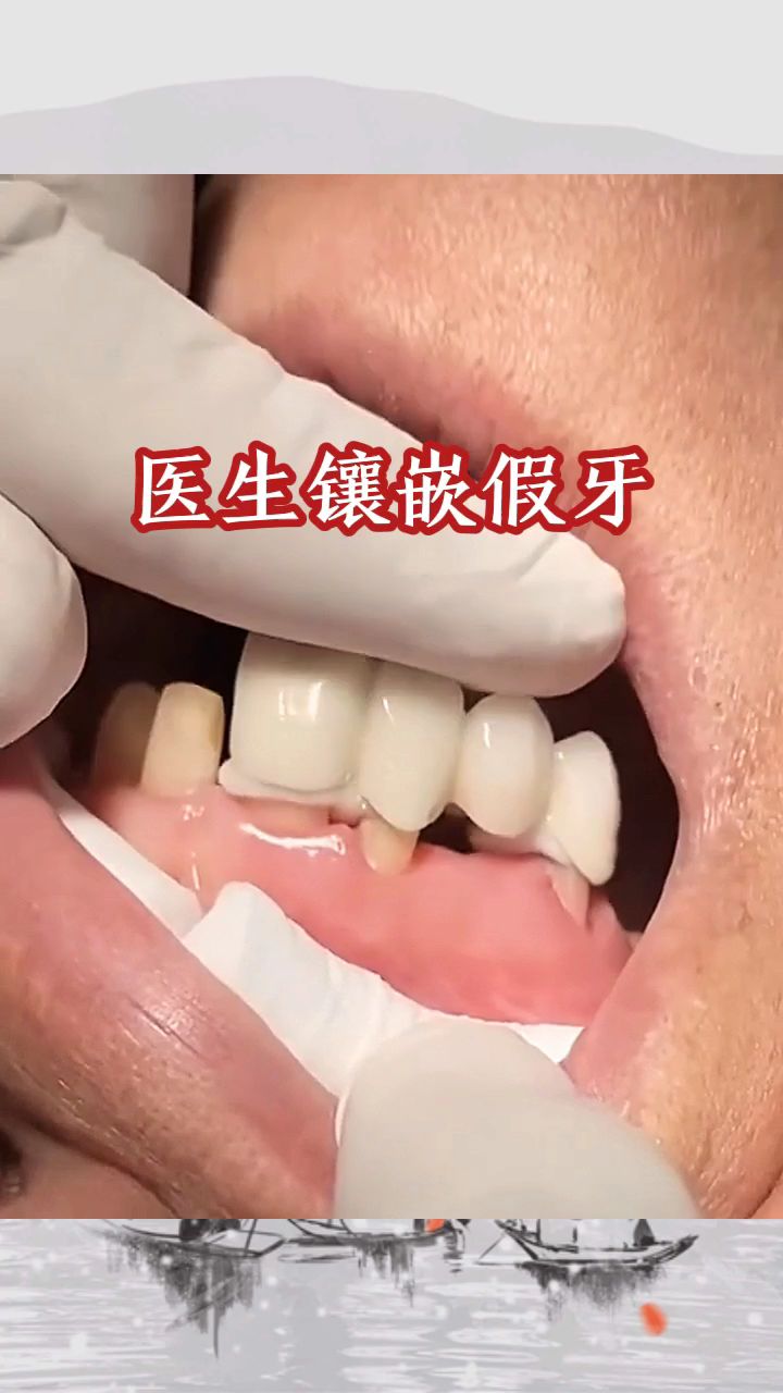 医生镶嵌假牙,以假乱真