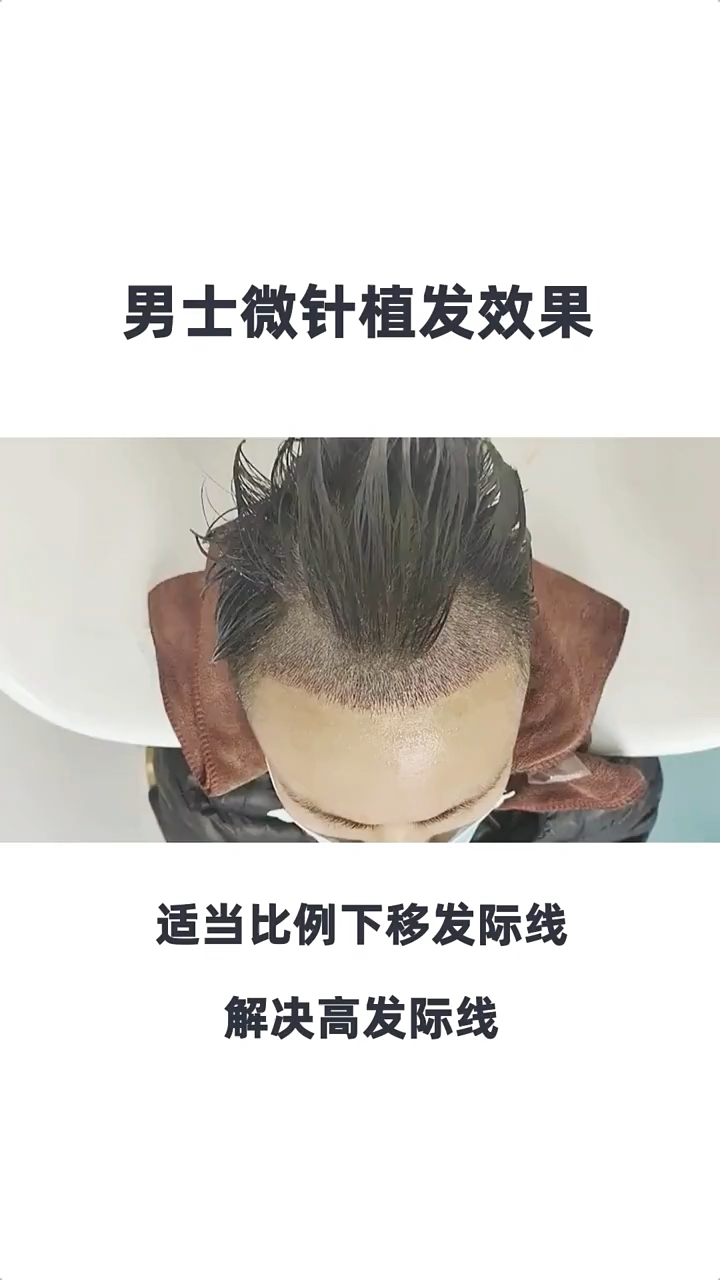 男士自己做植发(男士自己做植发好吗)