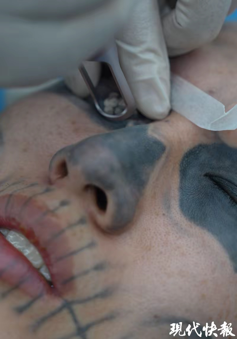 2000年出生的辽宁小伙晓龙近日做了个大胆的决定,要把脸上的纹身