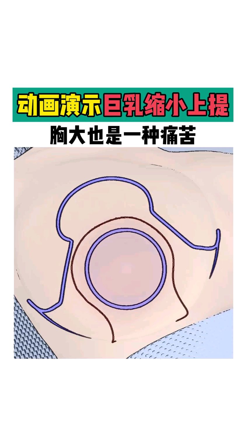 动画演示倒t法巨乳缩小怎么做