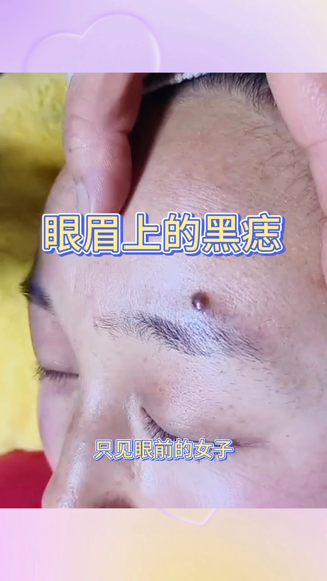 眼眉上的黑痣,居然是这样去除的