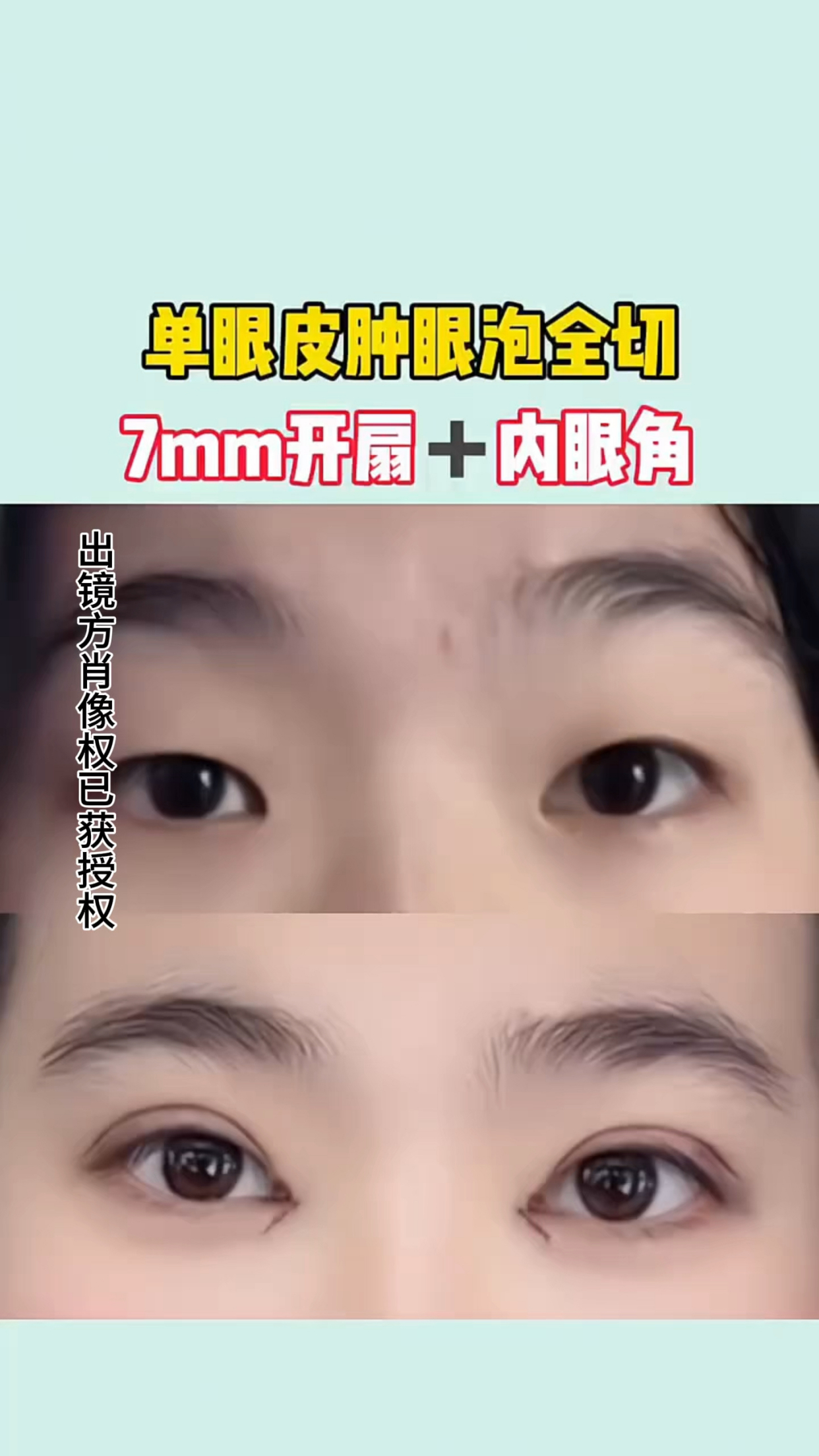 单眼皮肿眼泡全切,7mm开扇 内眼角