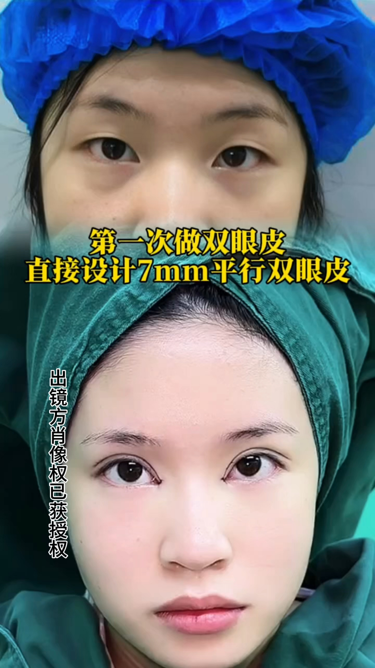 第一次做双眼皮,直接设计7mm平行双眼皮