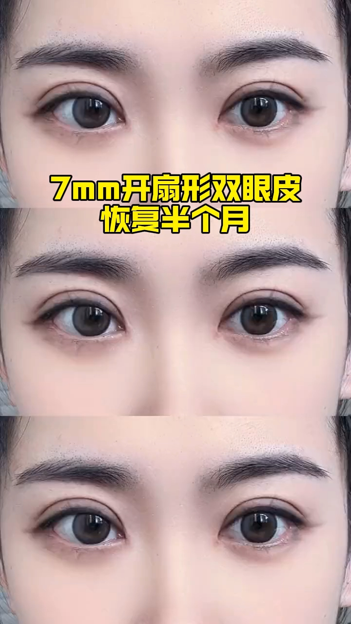 8mm双眼皮一年后图图片